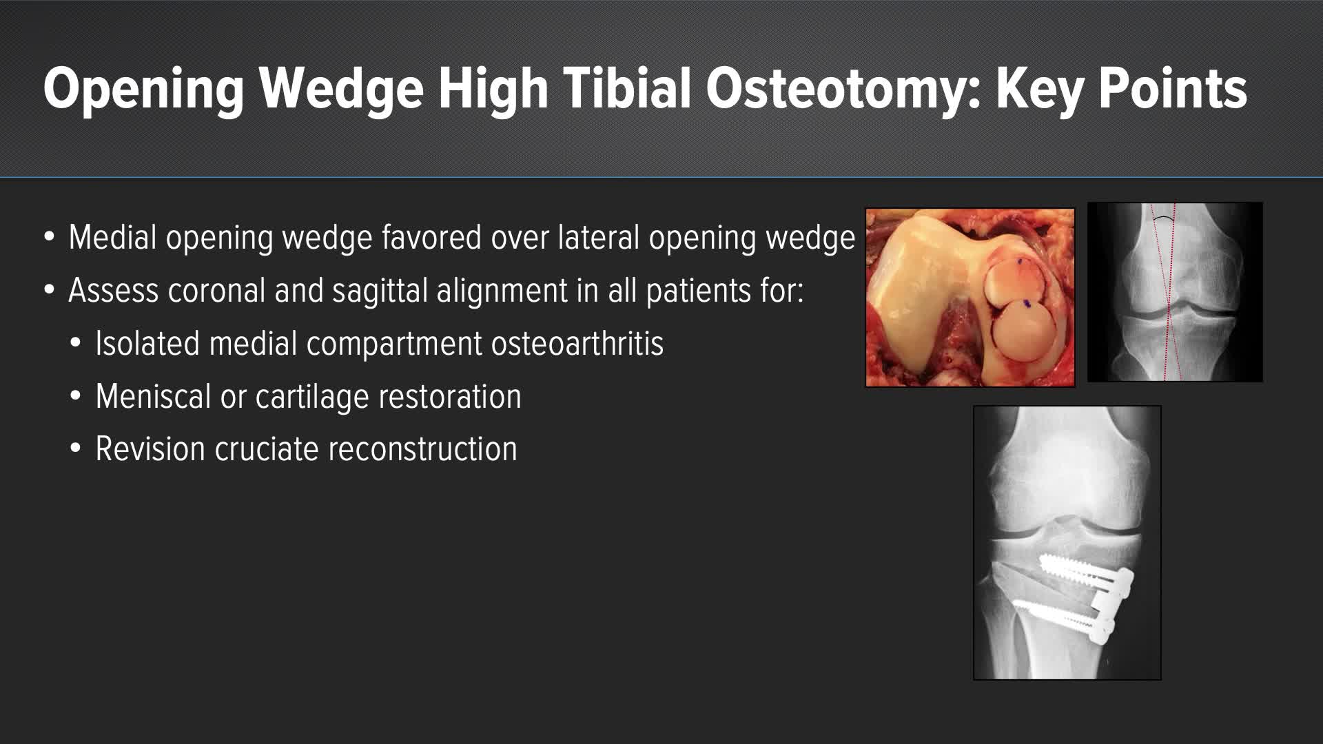 Arthrex - High Tibial Osteotomy to Correct Varus Malalignment