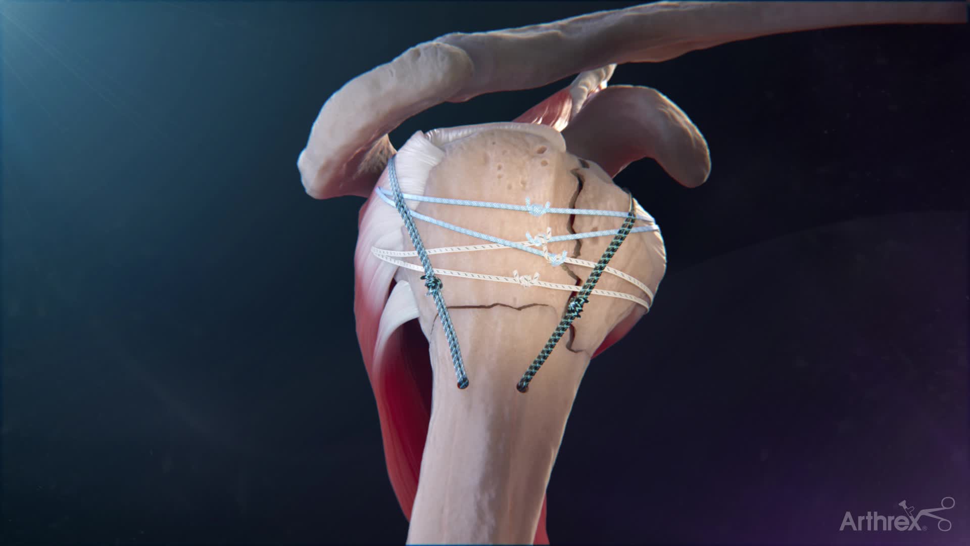 Arthrex - FxBridge™ Tuberosity Repair System: Reverse Total