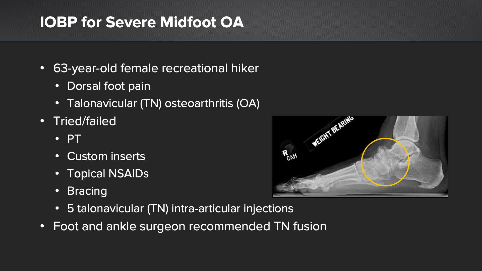 Arthrex - In-clinic IOBP® Procedure For Midfoot Osteoarthritis