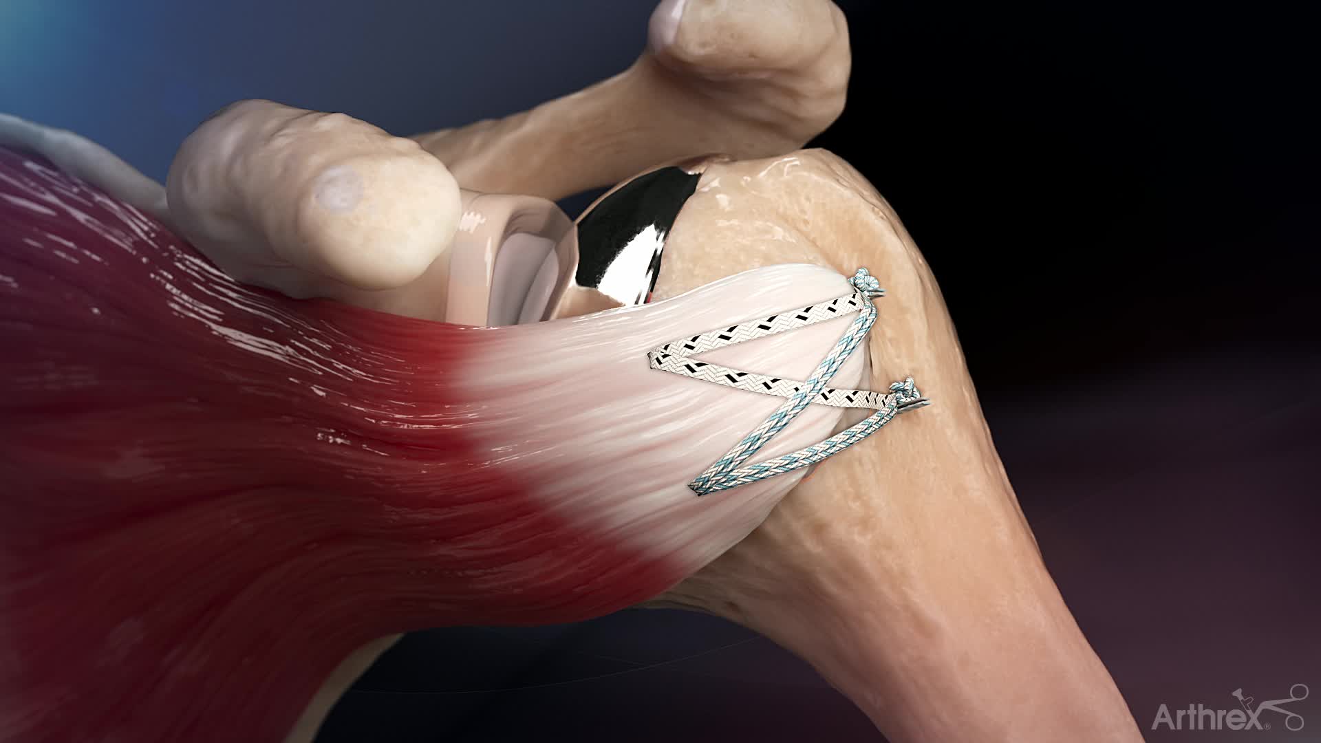【SOULESURES x SURGERY】SS008 triangle Arthrex - Arthrex Re-Live Surgical Technique: Univers Revers