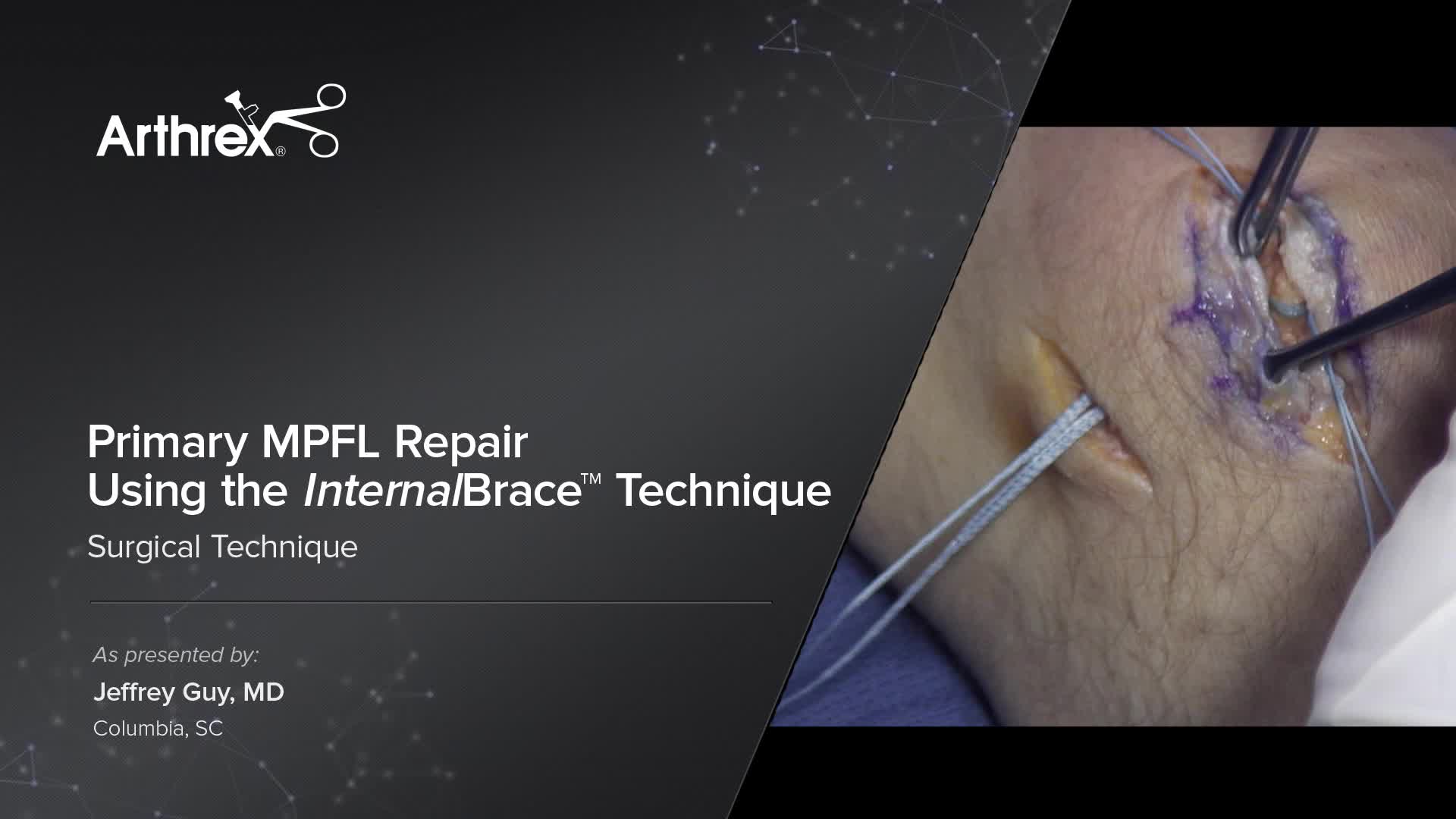 Arthrex Primary Mpfl Repair Using The Internalbrace Technique