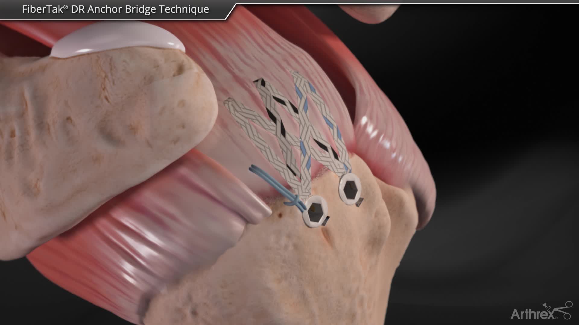 Arthrex - FiberTak® DR Anchor Bridge Technique