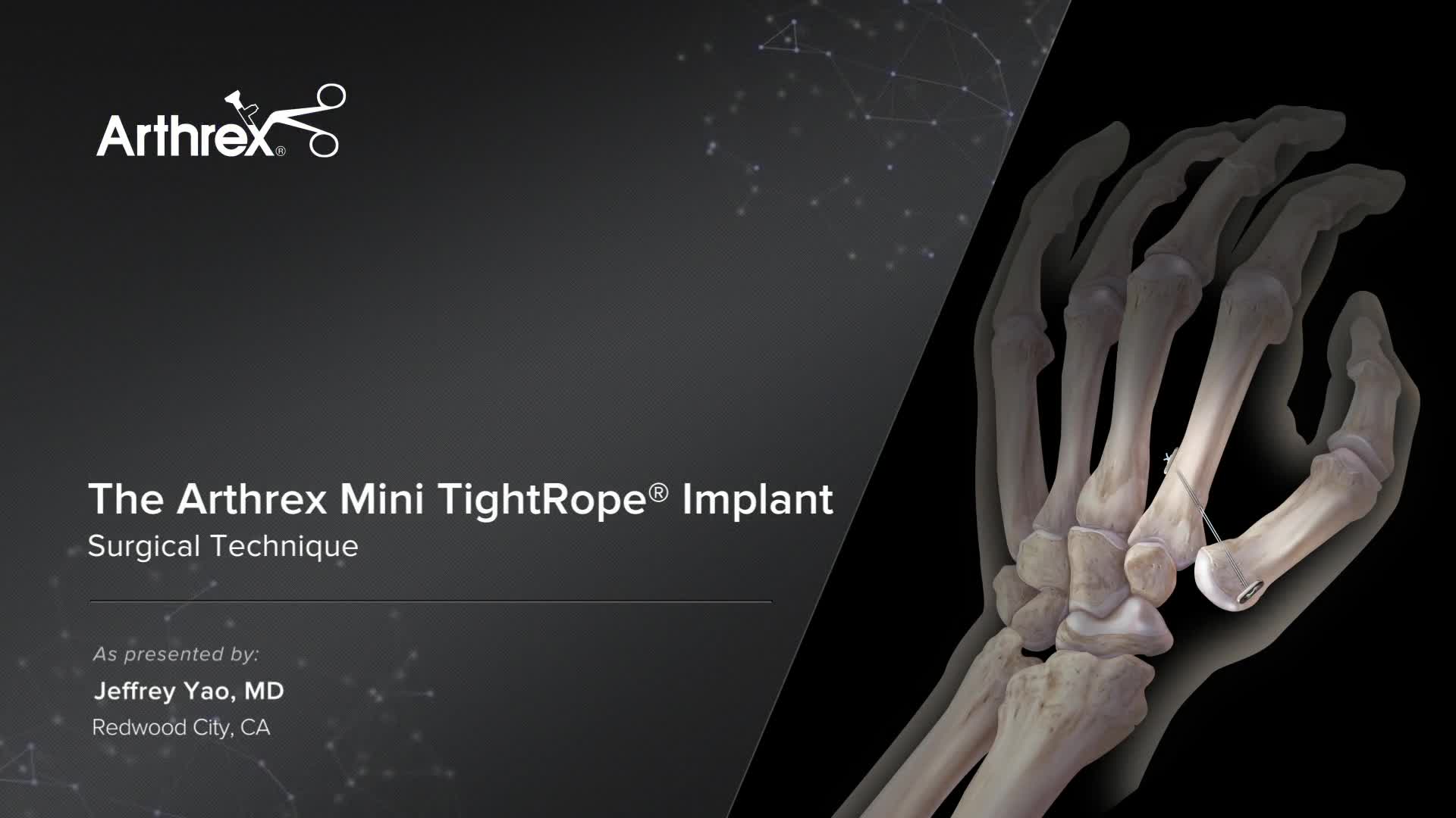 Arthrex - The Arthrex Mini TightRope® Implant