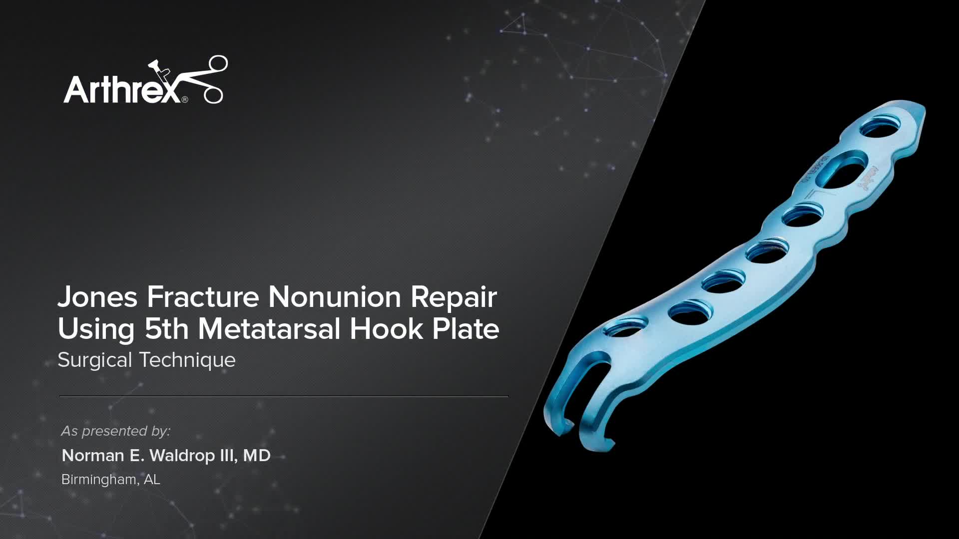 Arthrex Jones Fracture Nonunion Repair Using Th Metatarsal Hook Plate