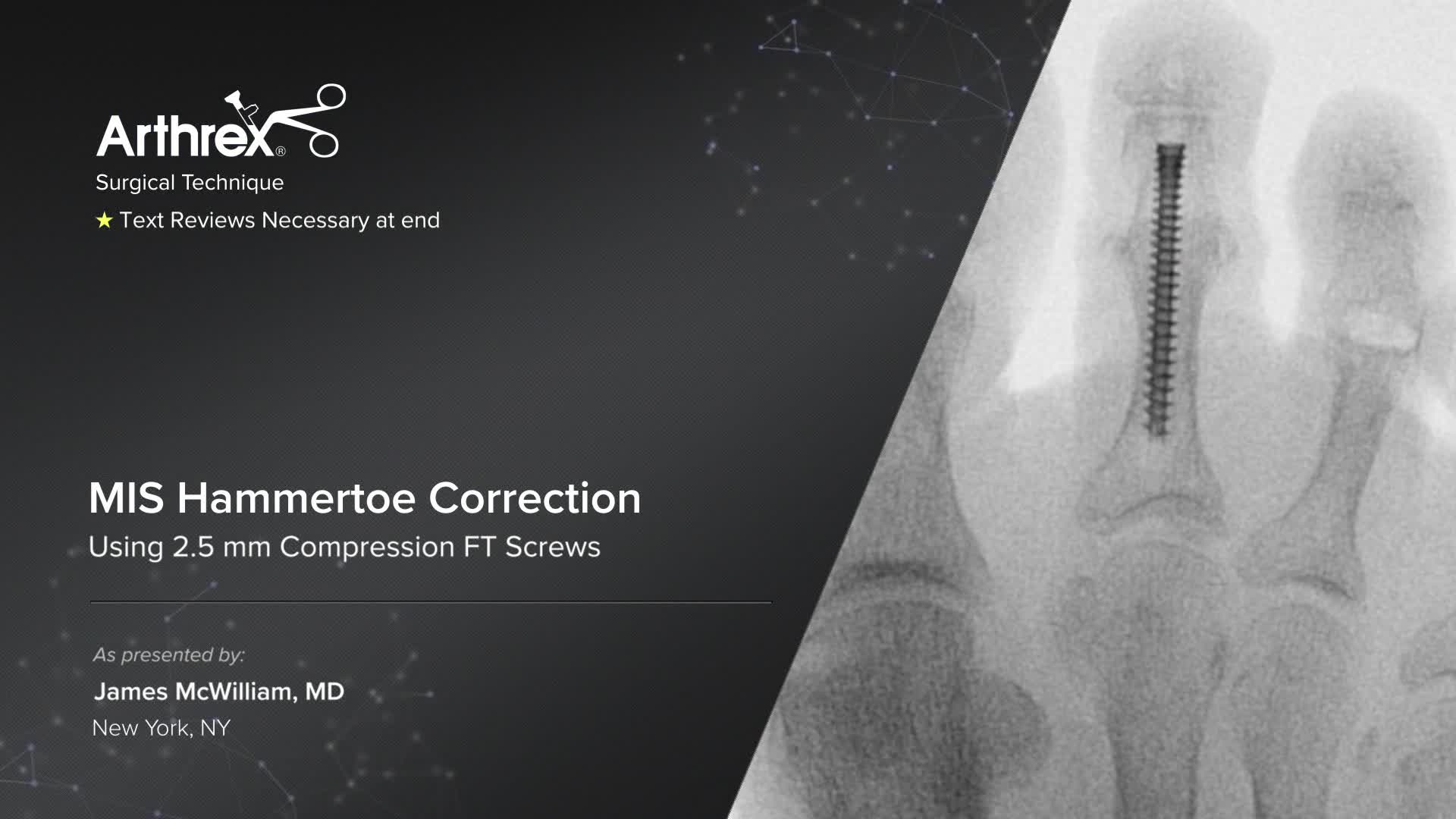 Arthrex - MIS Hammertoe Correction Using 2.5 mm Compression FT Screws