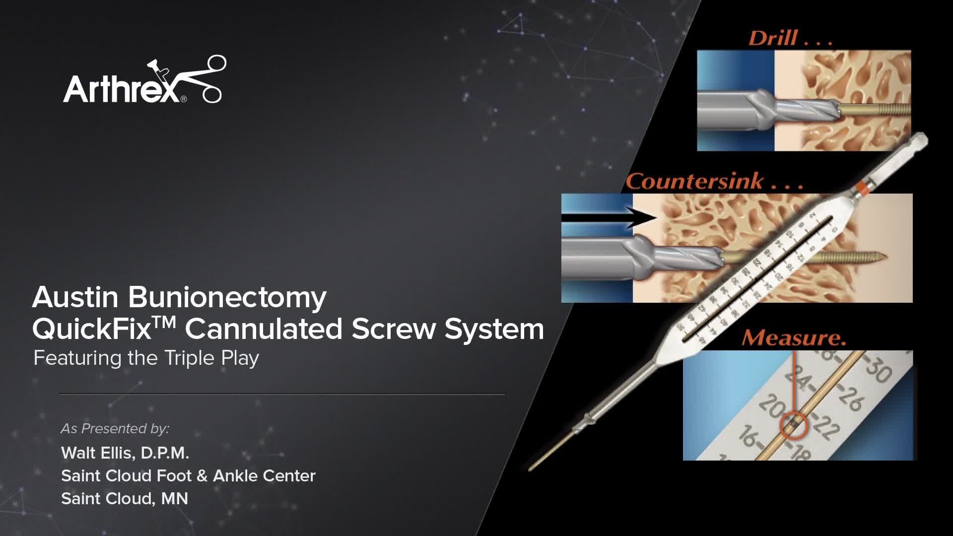 Arthrex Austin Bunionectomy Quickfix Cannulated Screw System