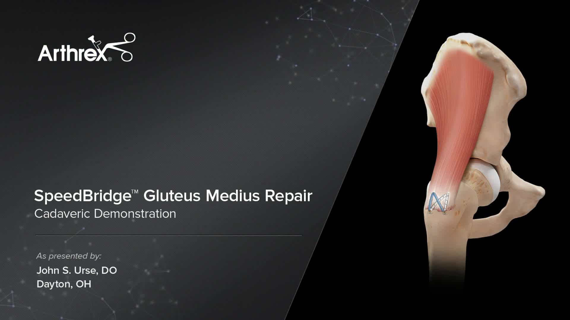 Arthrex speedbridge gluteus medius repair