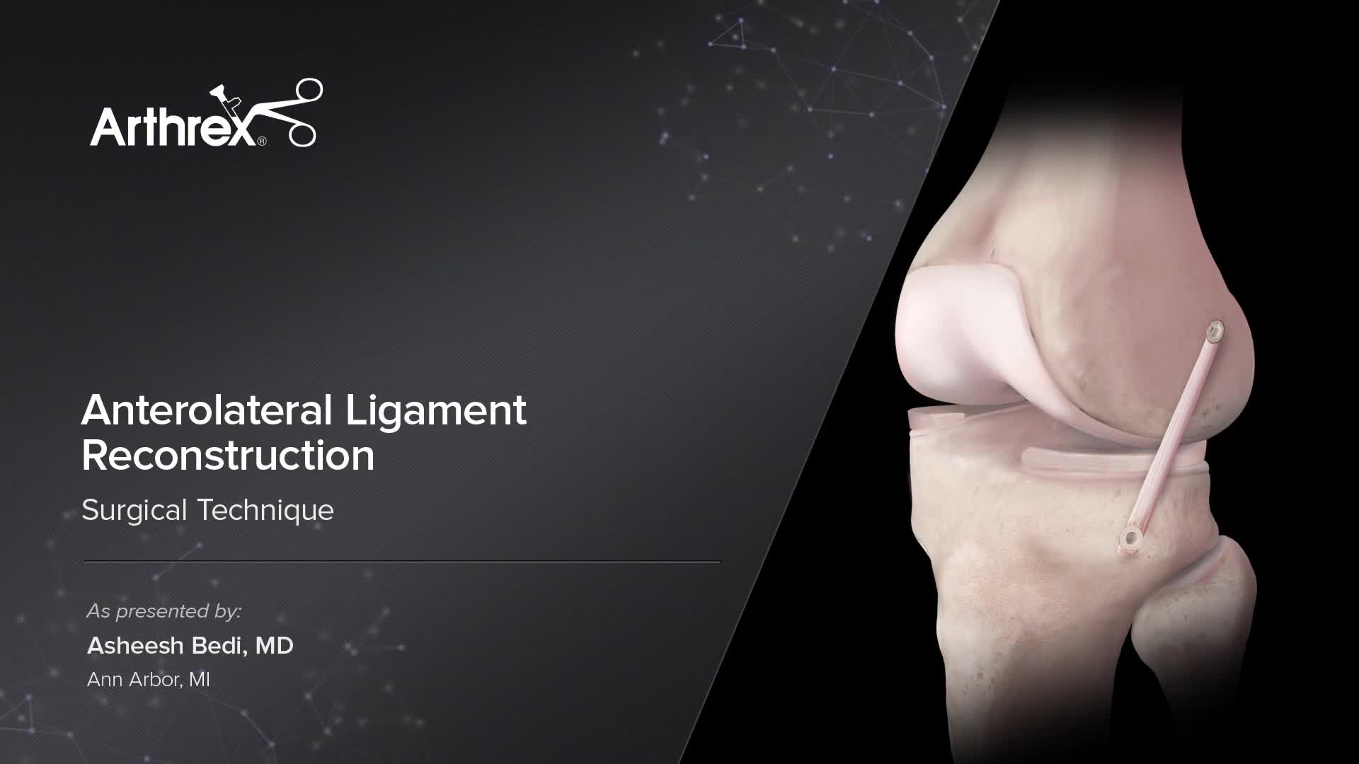 Arthrex - Anterolateral Ligament Reconstruction