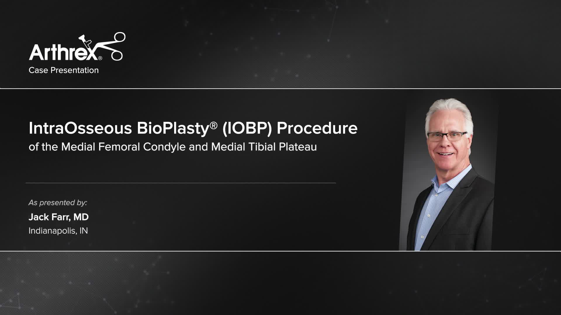 Arthrex - IntraOsseous BioPlasty® (IOBP) Procedure Of The Medial ...