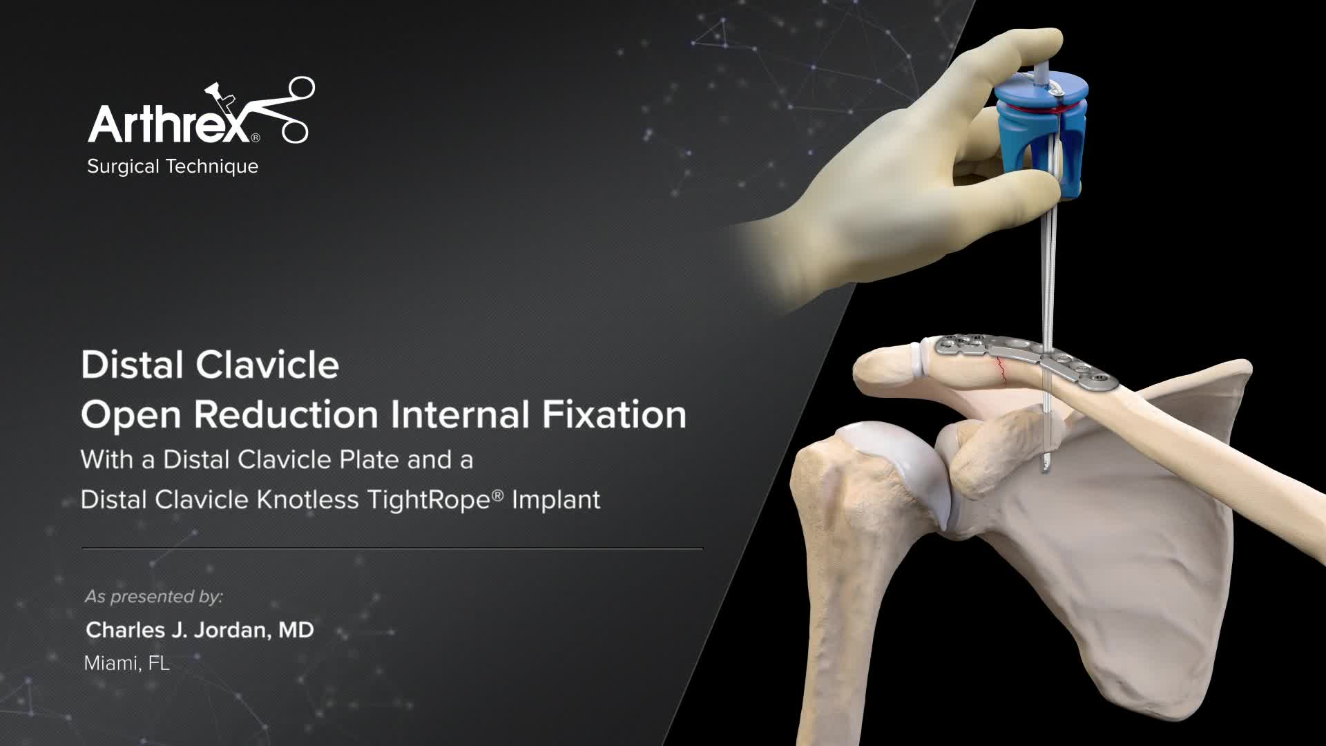 Arthrex - Distal Clavicle Open Reduction Internal Fixation With a