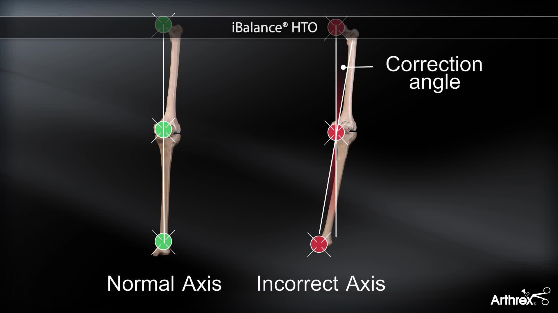 Arthrex - iBalance® HTO Arthrex - iBalance® HTO