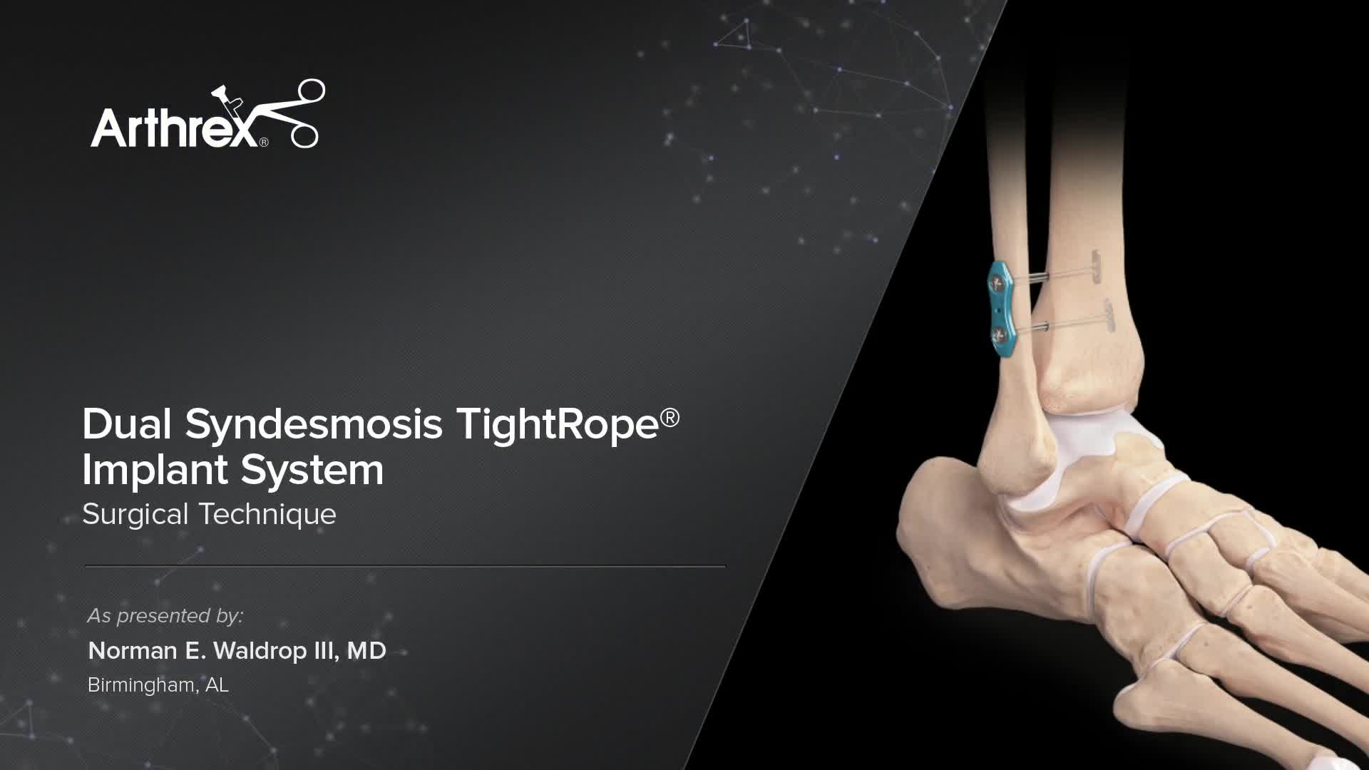 Arthrex - Dual Syndesmosis TightRope® Implant System
