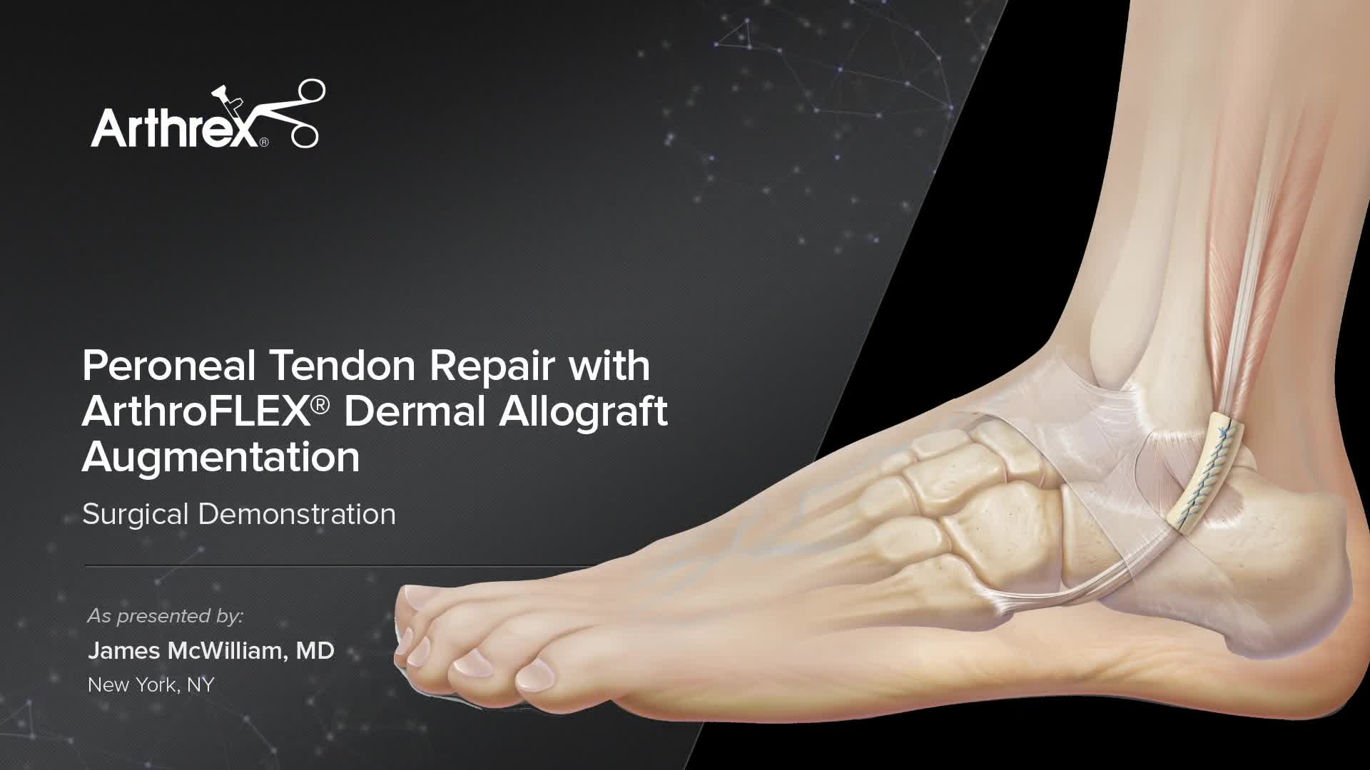 Arthrex Peroneal Tendon Repair With Arthroflex® Dermal Allograft