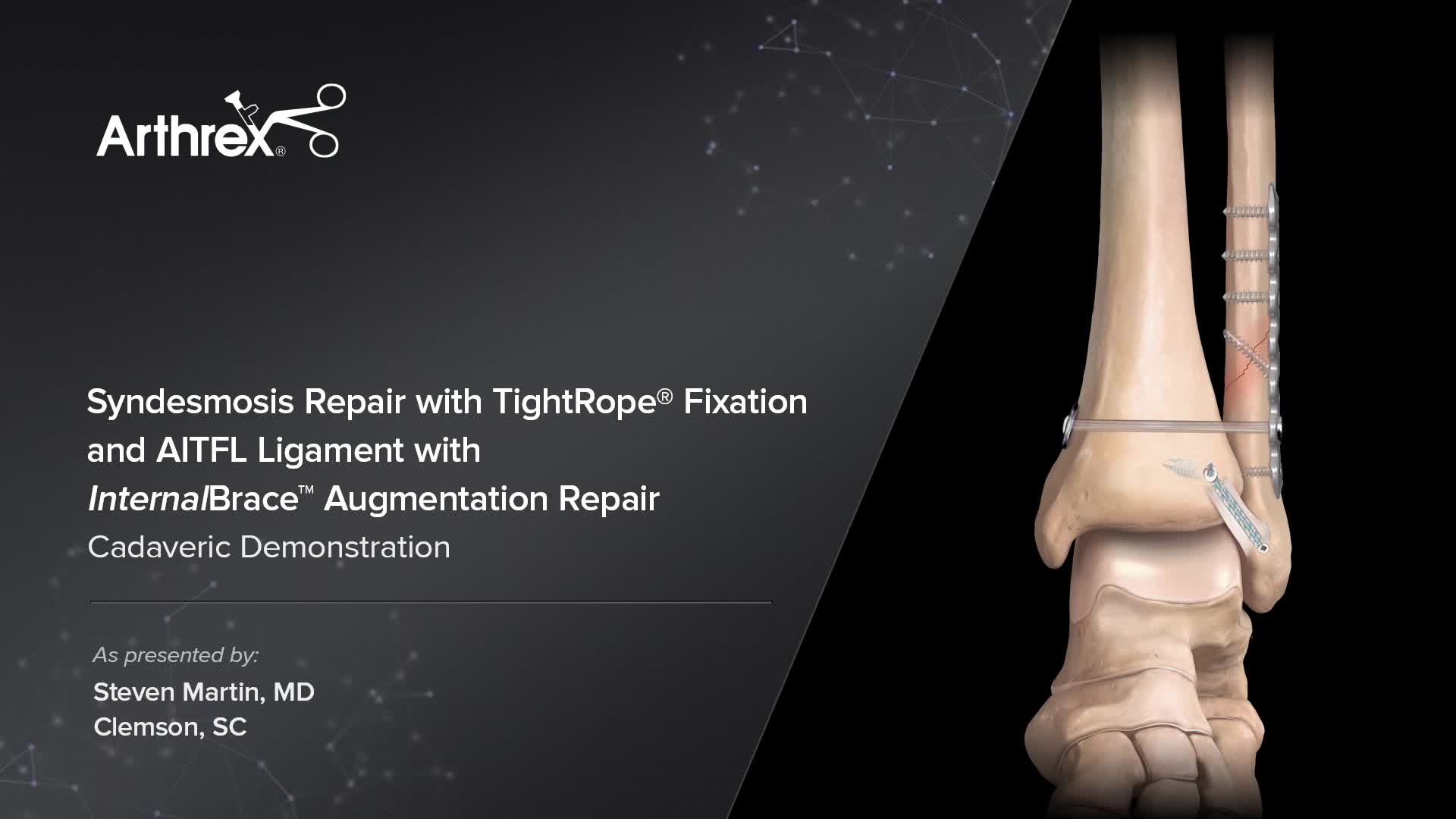 Arthrex - Syndesmosis Repair With TightRope® Fixation and AITFL Ligament  Repair With InternalBrace™ Ligament Augmentation
