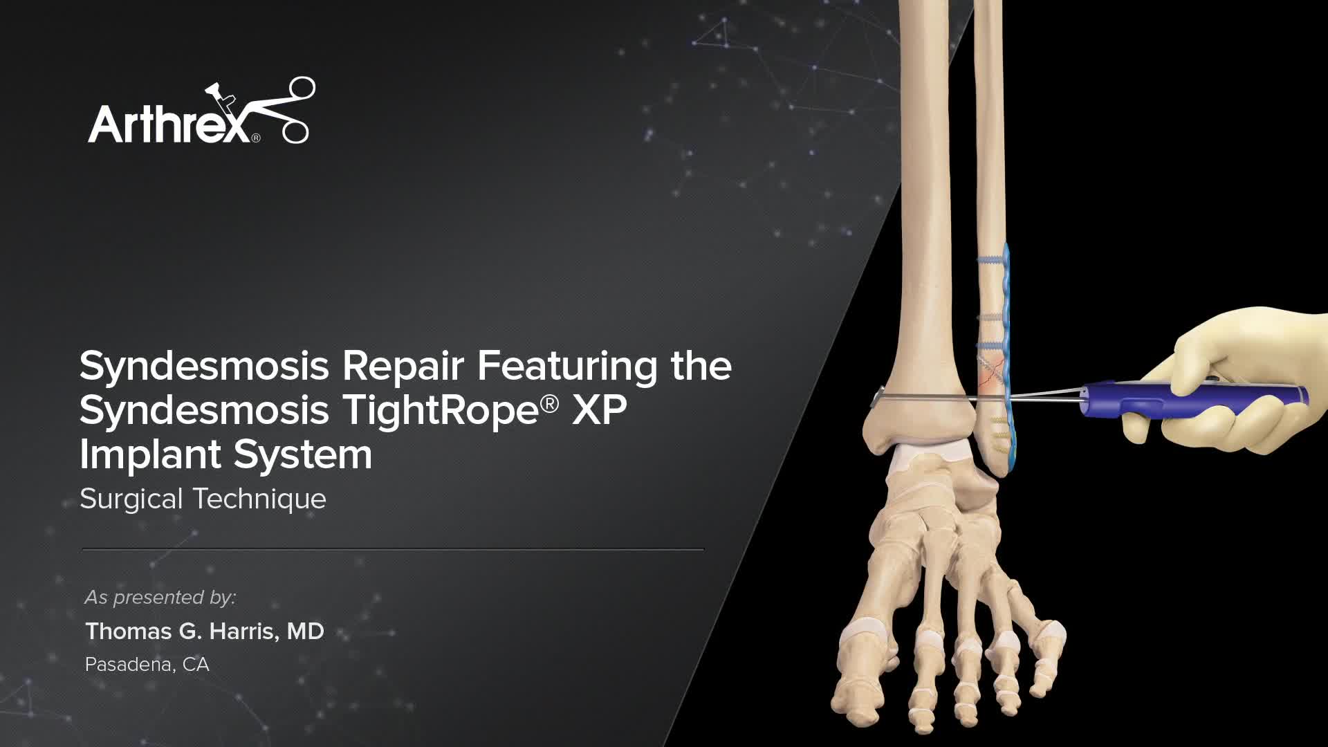Arthrex - Syndesmosis Repair Featuring the Syndesmosis TightRope® XP  Implant System
