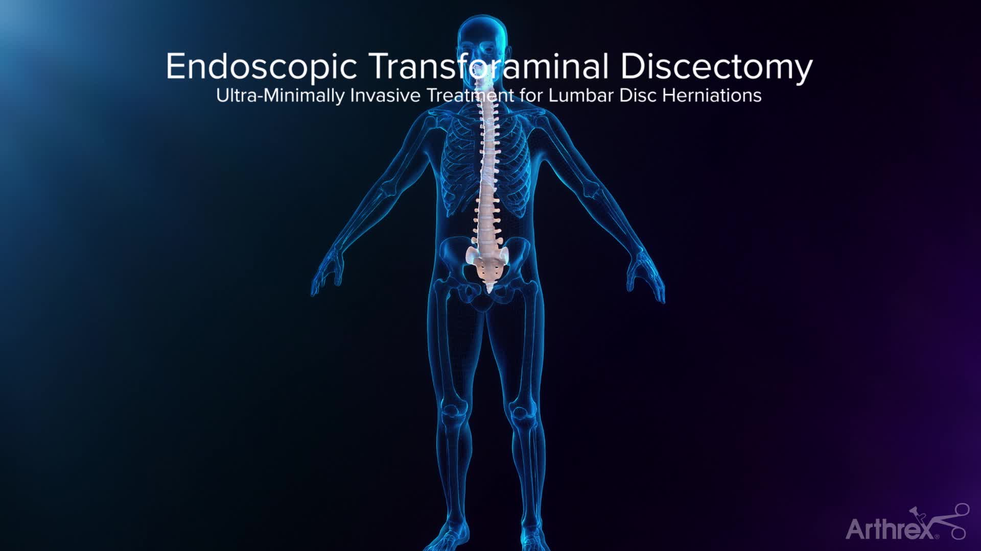 Arthrex - Endoscopic Transforaminal Approach for a Herniated Disc