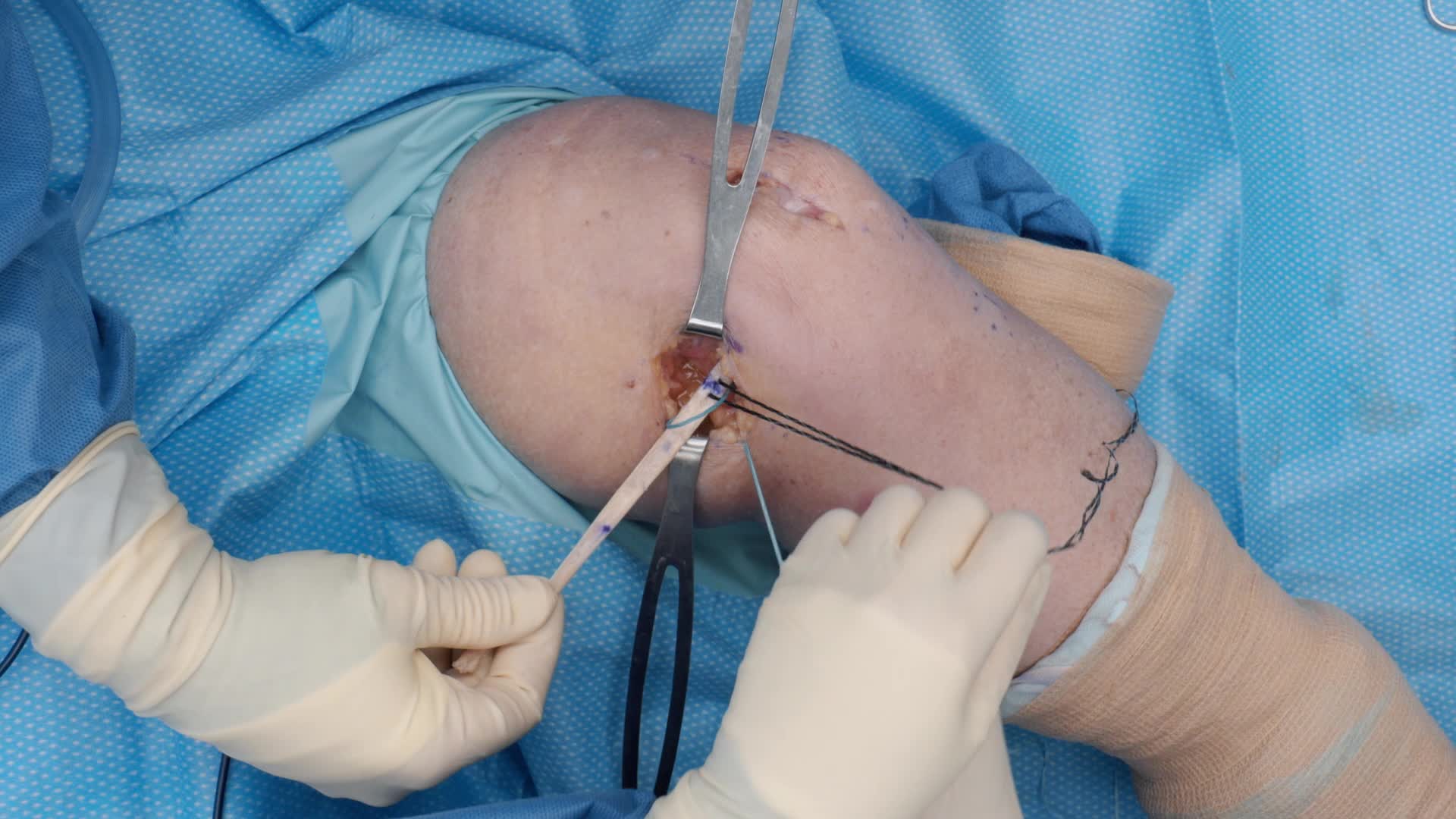 Arthrex - Medial Quadriceps Tendon Femoral Ligament (MQTFL