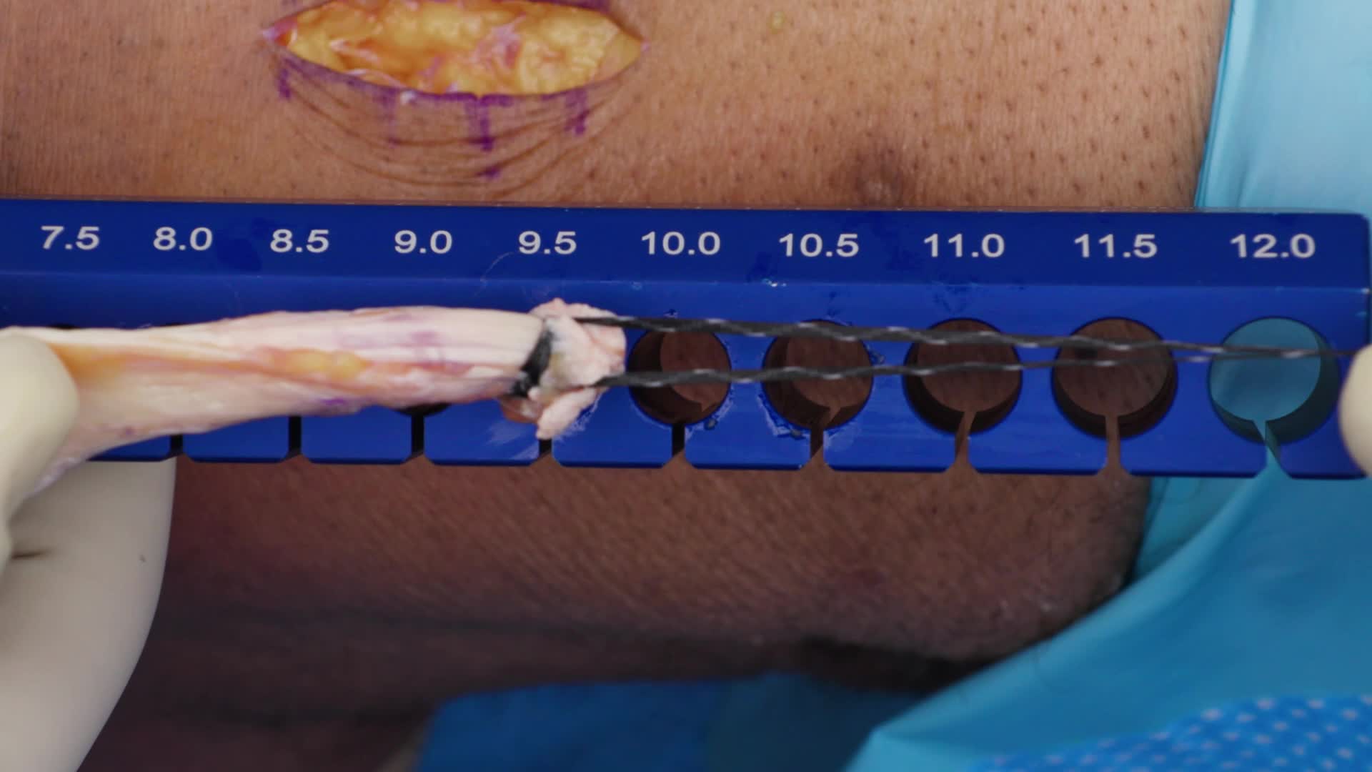 Arthrex Minimally Invasive Quad Tendon Graft Harvest From A Proximal Approach Using The