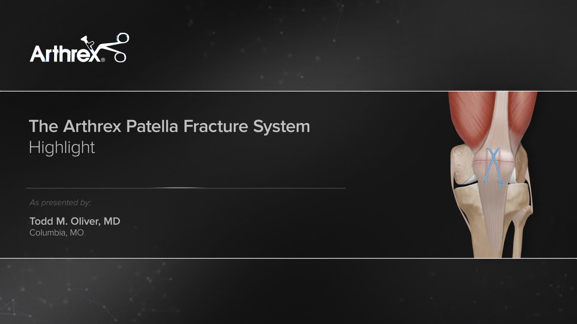 Arthrex - The Arthrex Patella Fracture System