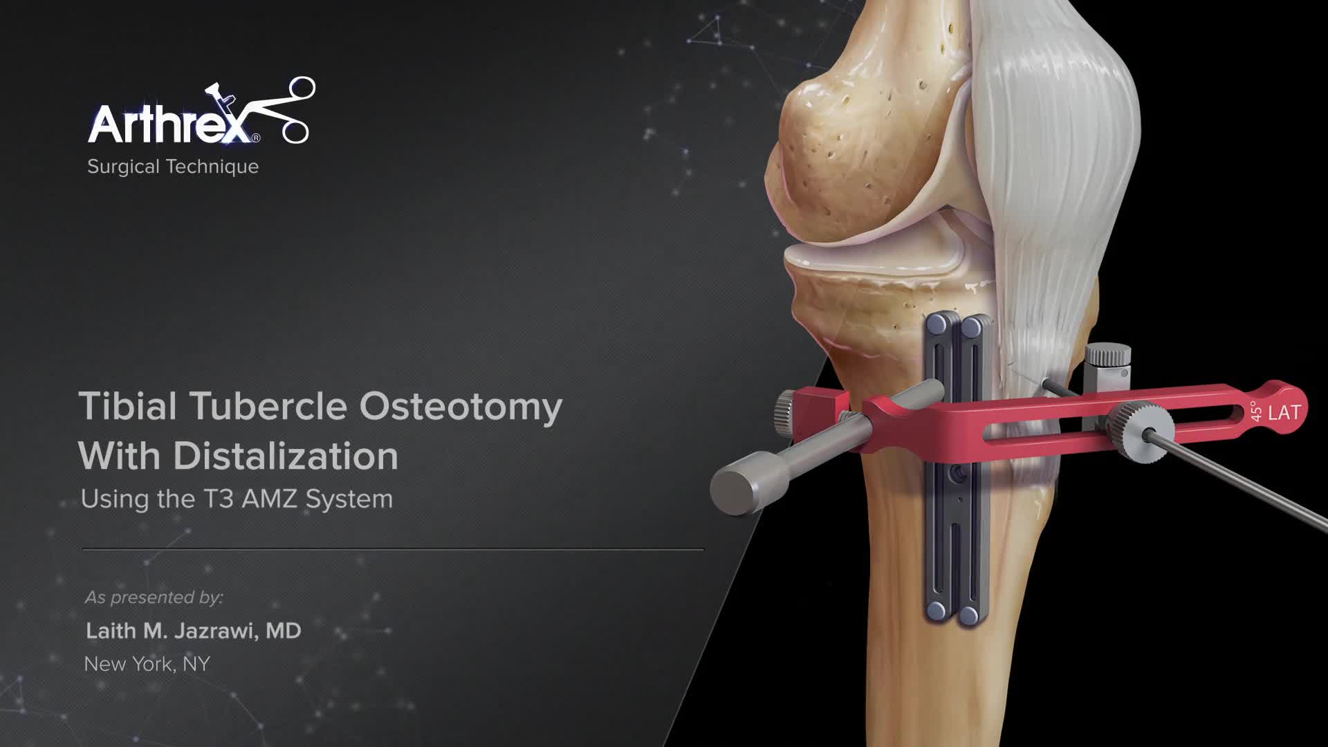 Arthrex - Tibial Tubercle Osteotomy With Distalization Using