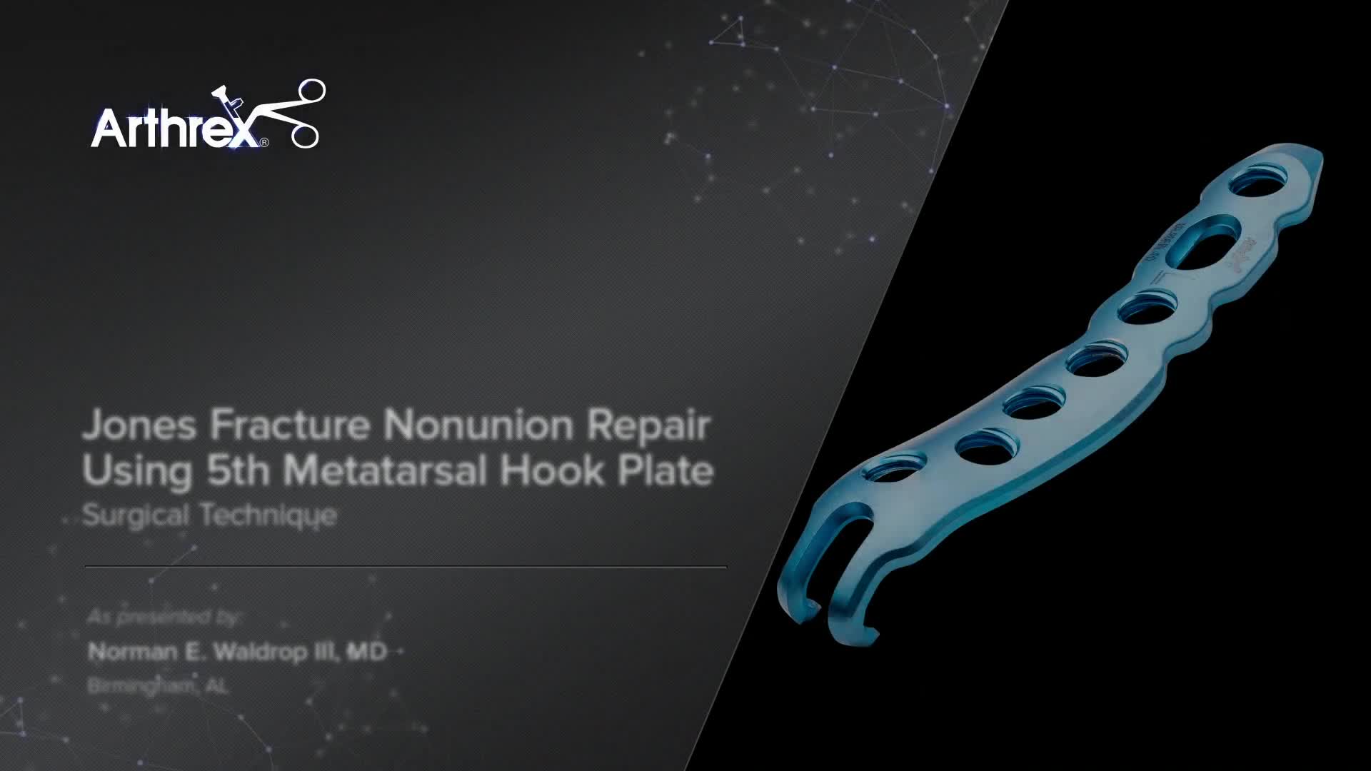 Arthrex - Jones Fracture Nonunion Repair Using 5th