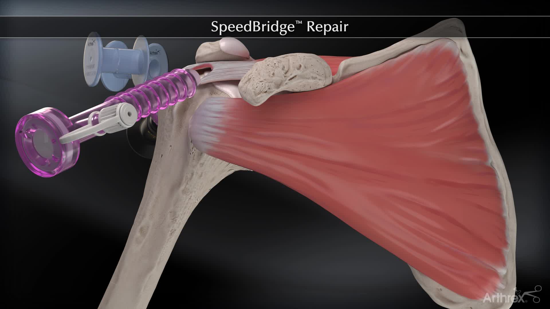 Arthrex - SpeedBridge™ Repair