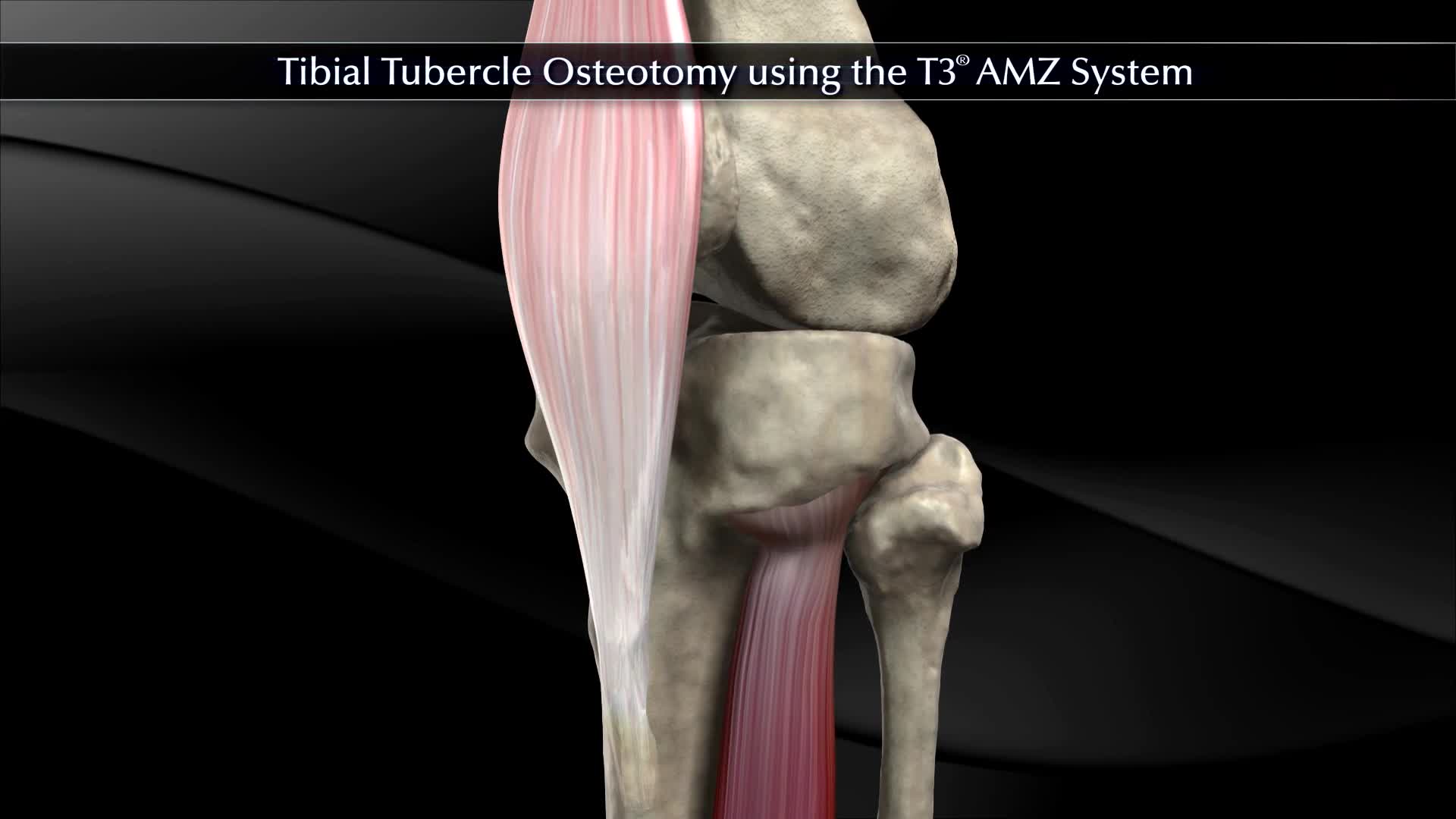 Knee Osteotomy アップデート fsurg-09-999208-g001.jpg