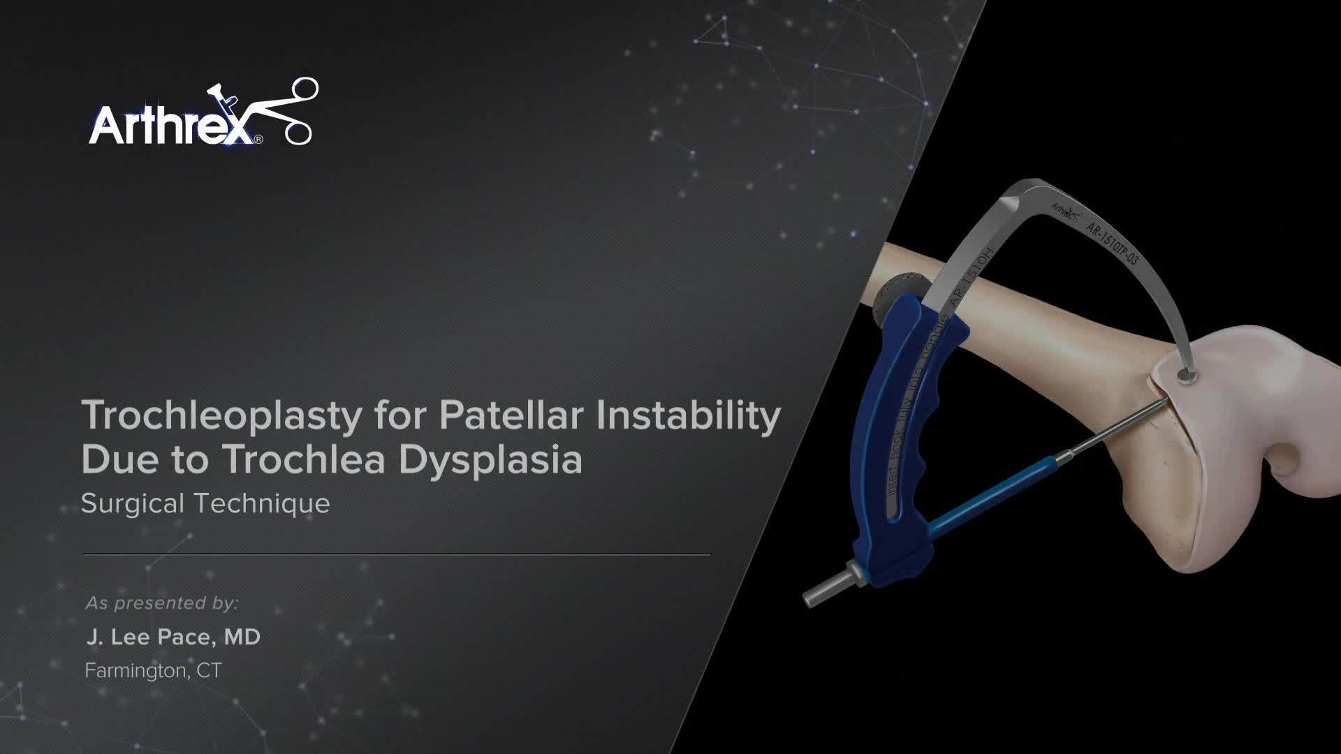 Arthrex - Trochleoplasty for Patellar Instability Due to