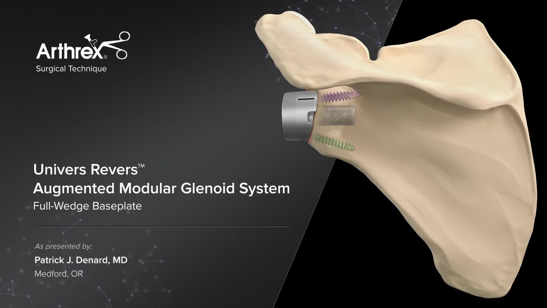 【SOULESURES x SURGERY】SS008 triangle Arthrex - Arthrex Re-Live Surgical Technique: Univers Revers