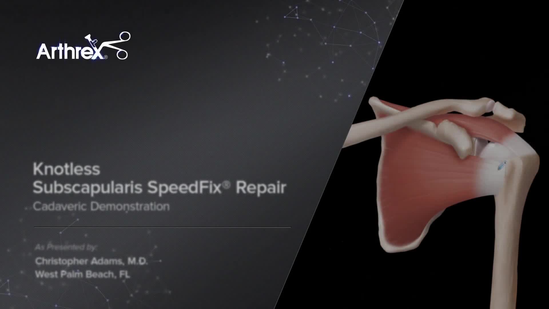 Arthrex - Knotless Subscapularis SpeedFix™ Repair Cadaveric