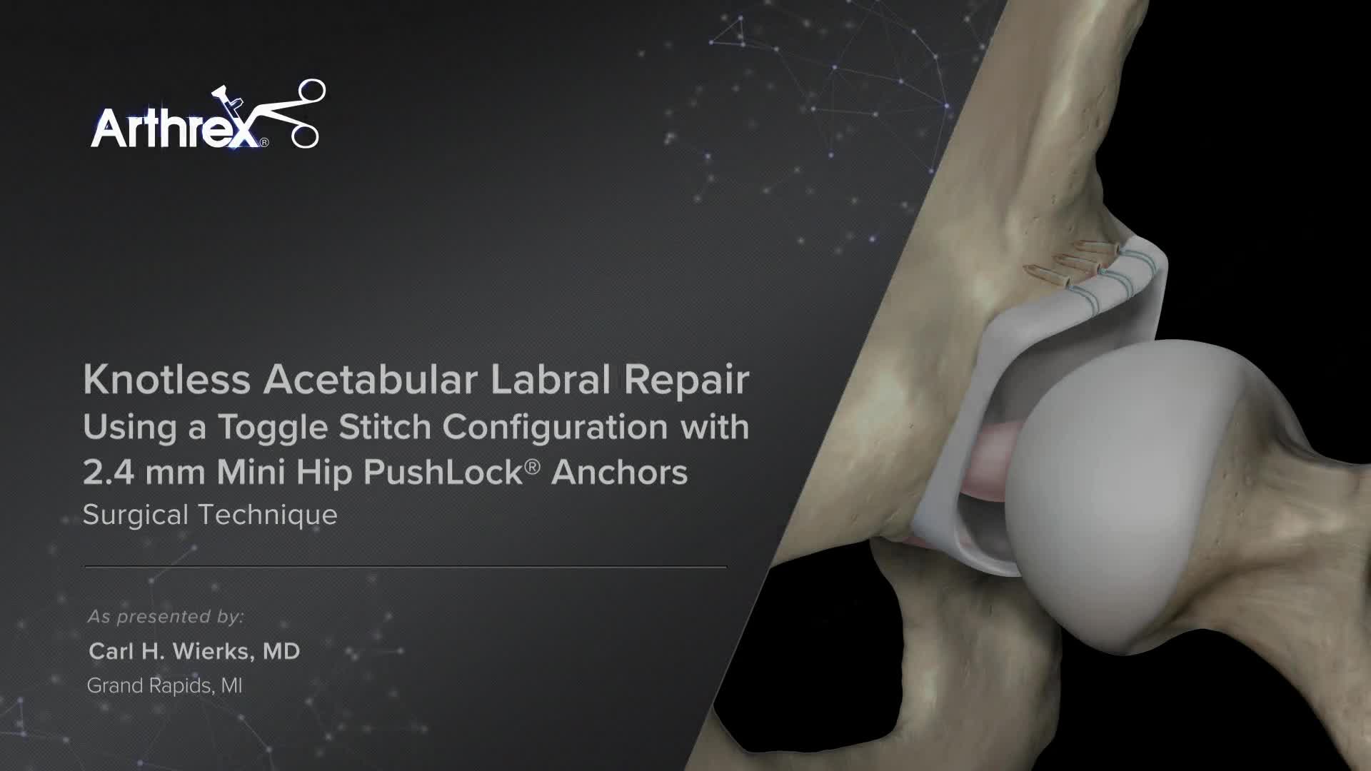 骨盤骨折　Surgical technique Arthrex - Knotless Acetabular Labral Repair Using a Toggle