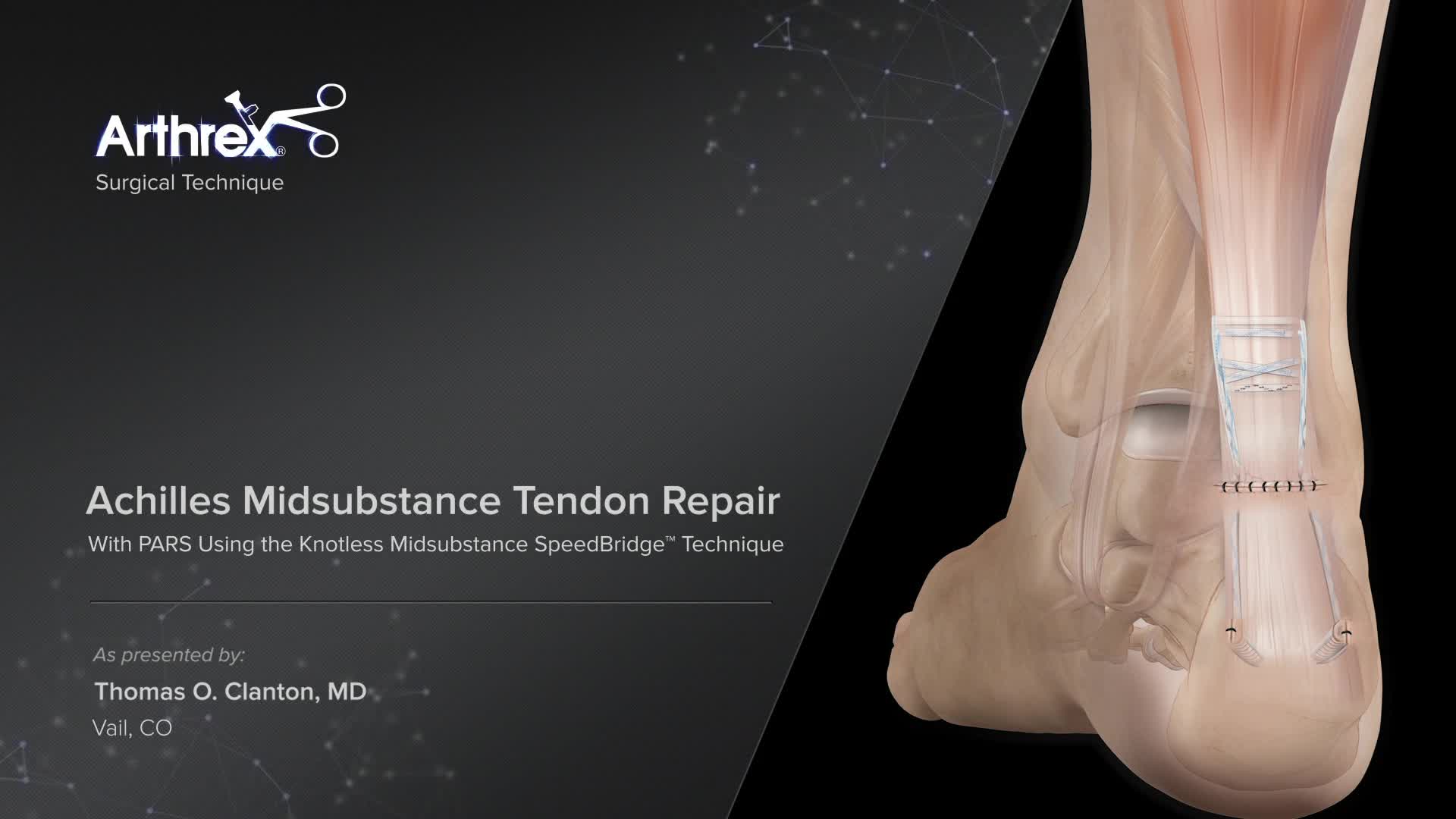 Arthrex - Achilles Midsubstance Tendon Repair With PARS