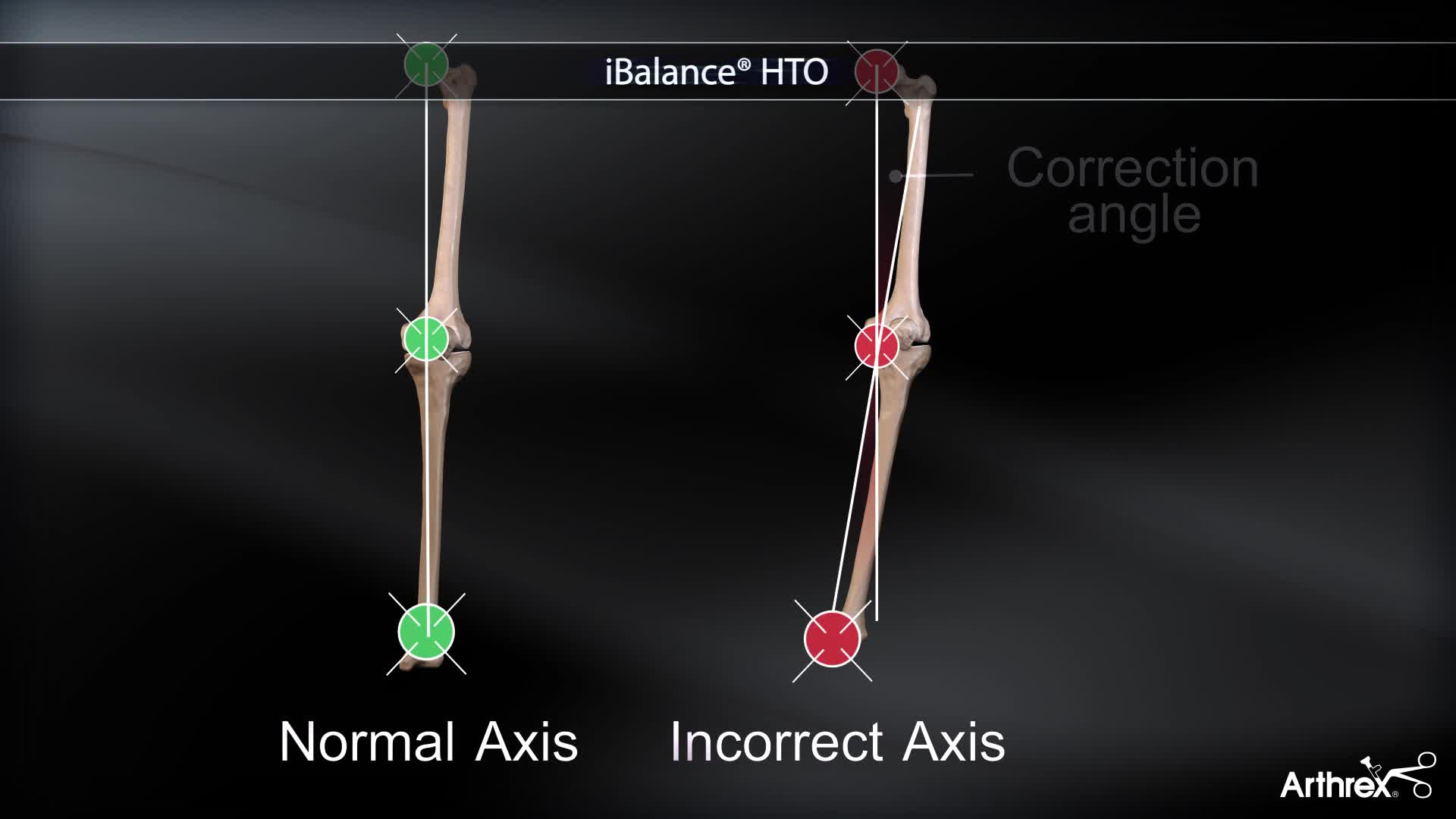 Arthrex - iBalance® HTO