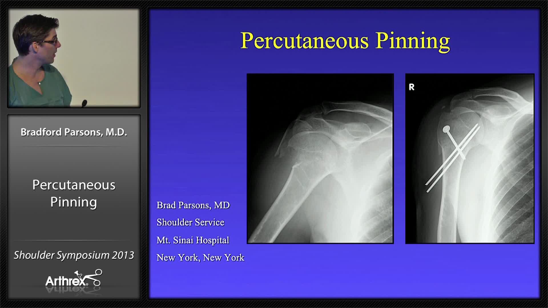 Arthrex Proximal Humeral Fractures Percutaneous Pinning