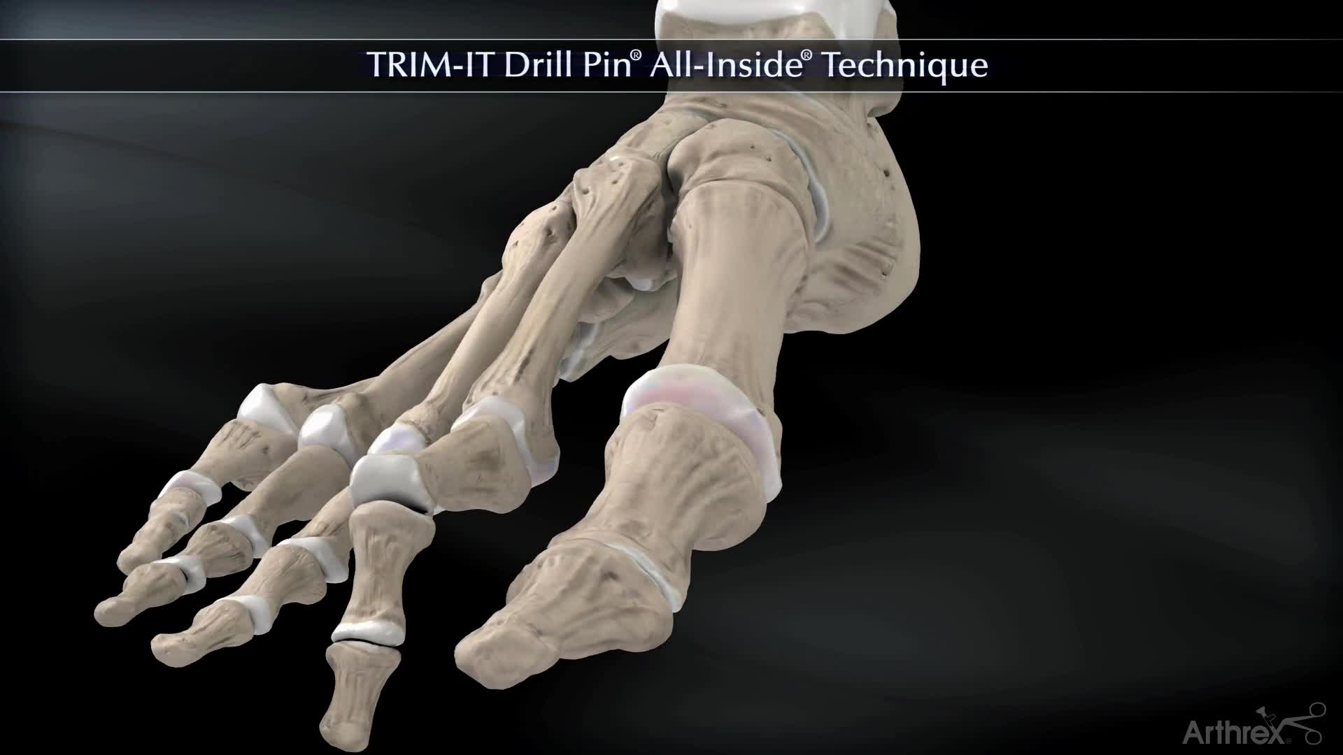 Arthrex - Trim-It Drill Pin® All-Inside Technique