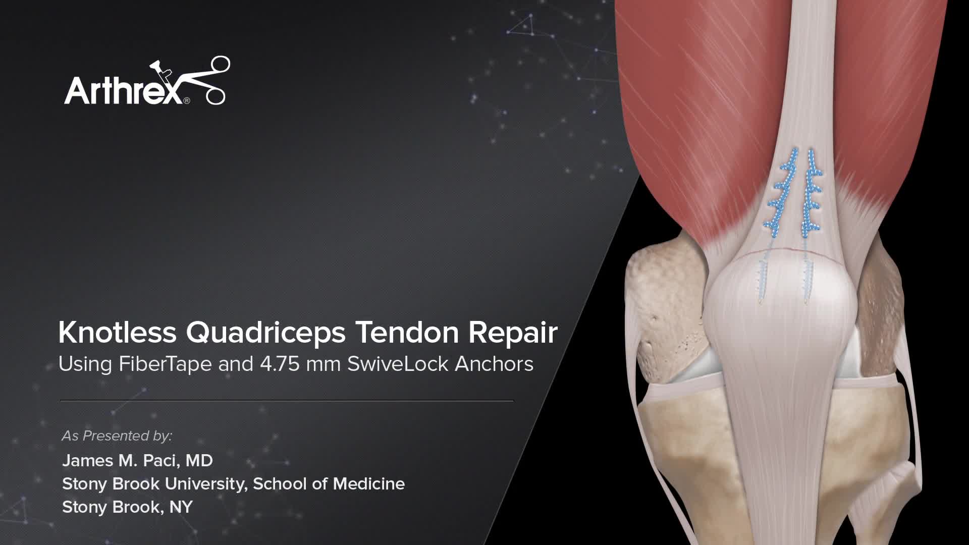 骨盤骨折　Surgical technique Arthroscopic Bony Bankart Lesion Fixation Using Knotless