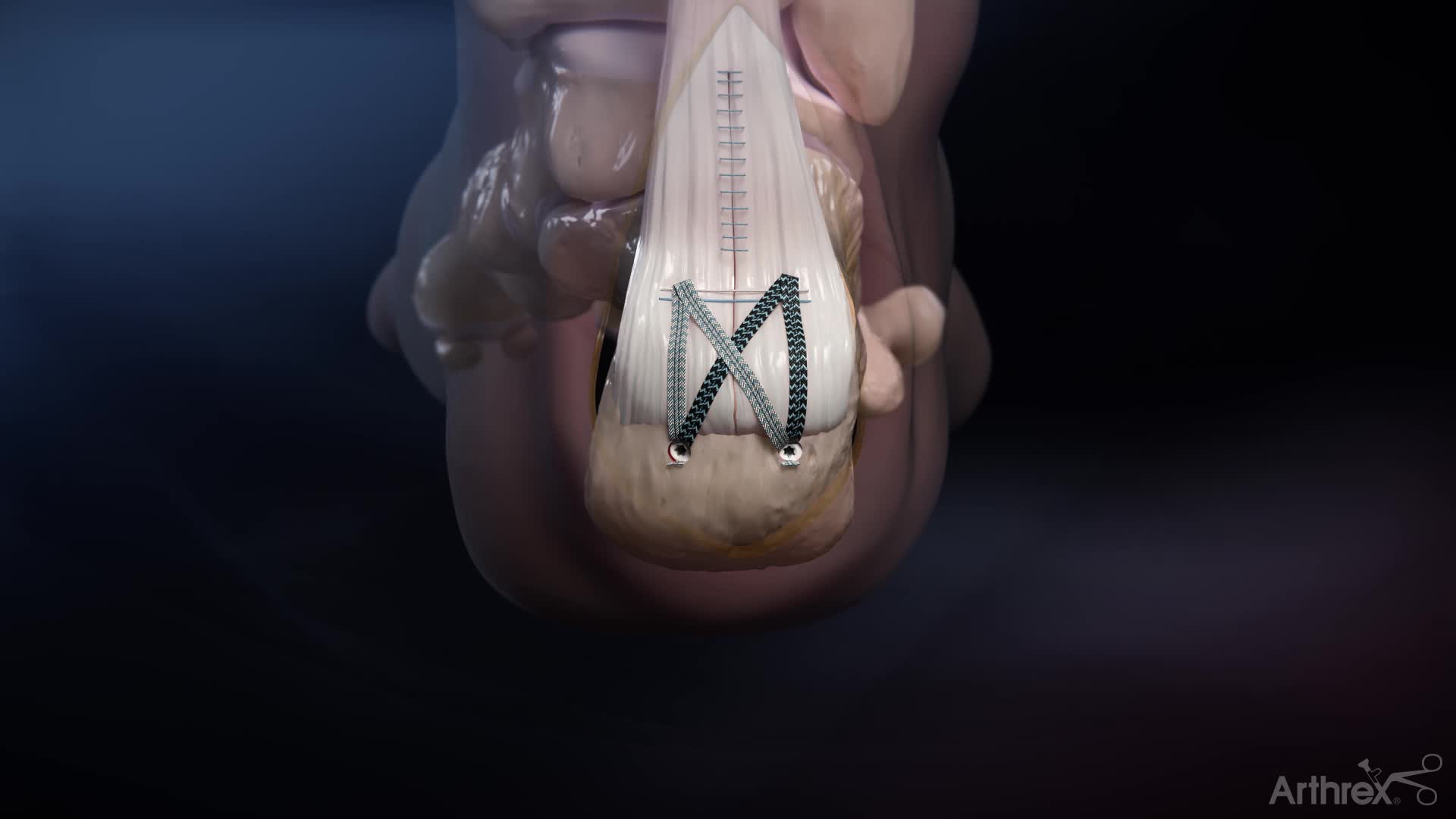 Arthrex Tips And Pearls For The Fibertak Achilles Speedbridge System