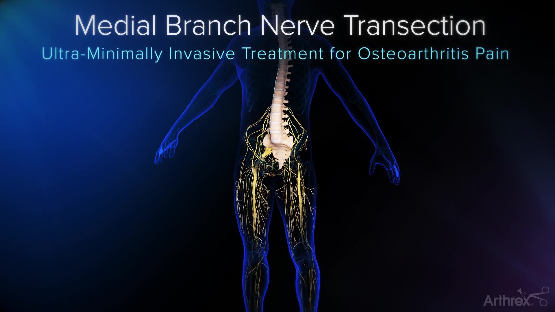 Arthrex - Endoscopic Medial Branch Nerve Transection