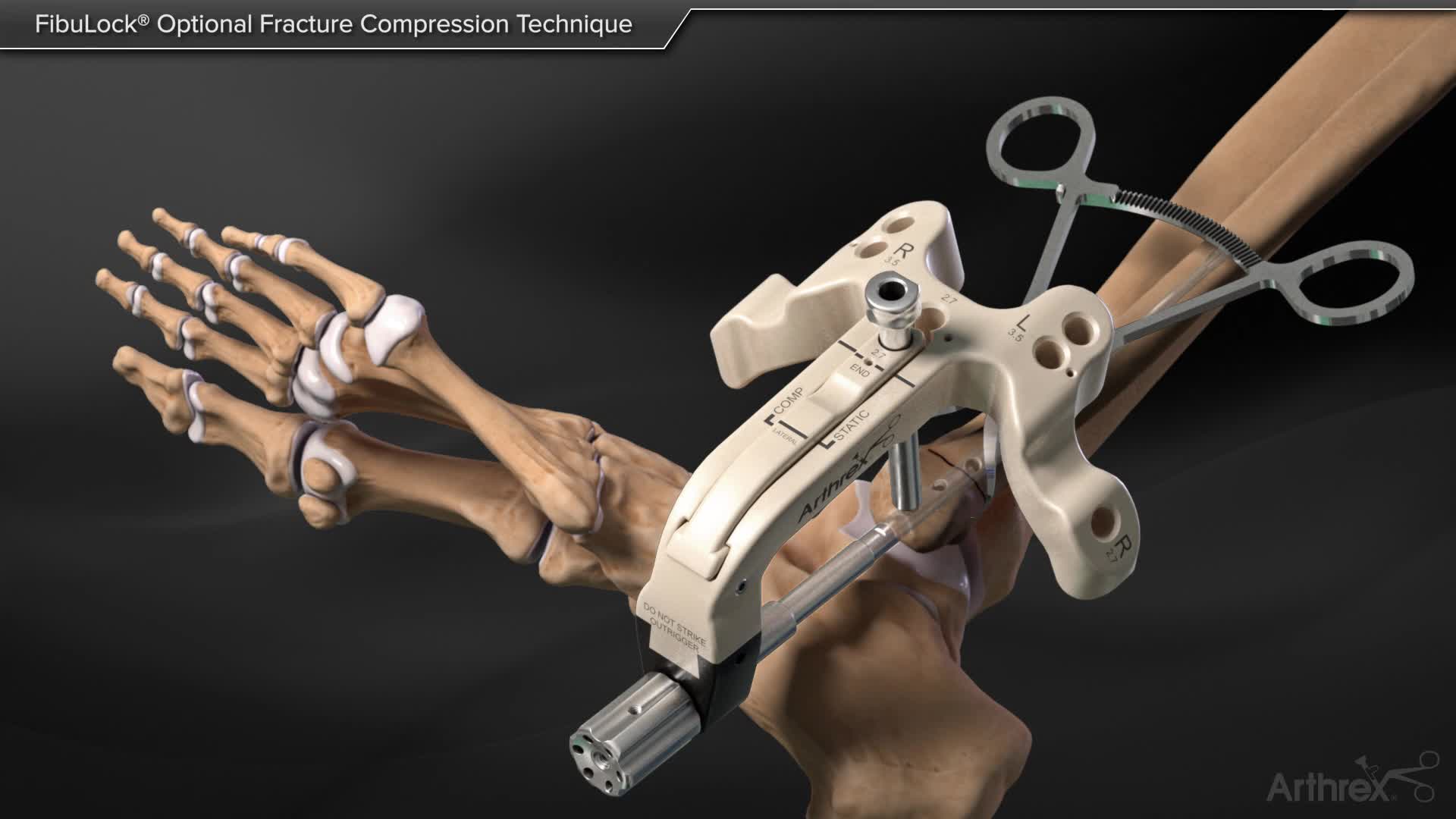 Arthrex FibuLock Fibular Nail Technique