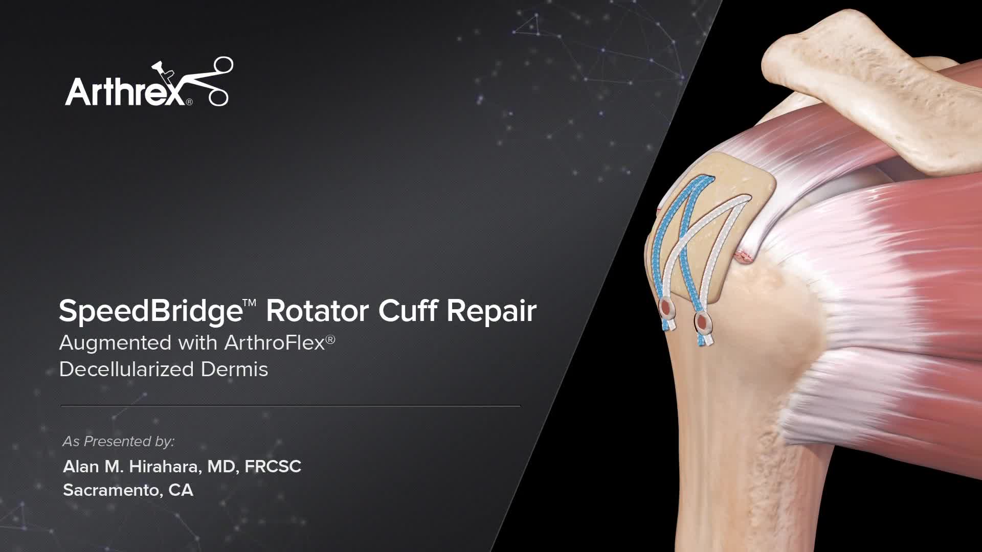 Arthrex Speedbridge Rotator Cuff Repair Augmented With Arthroflex Decellularized Dermis