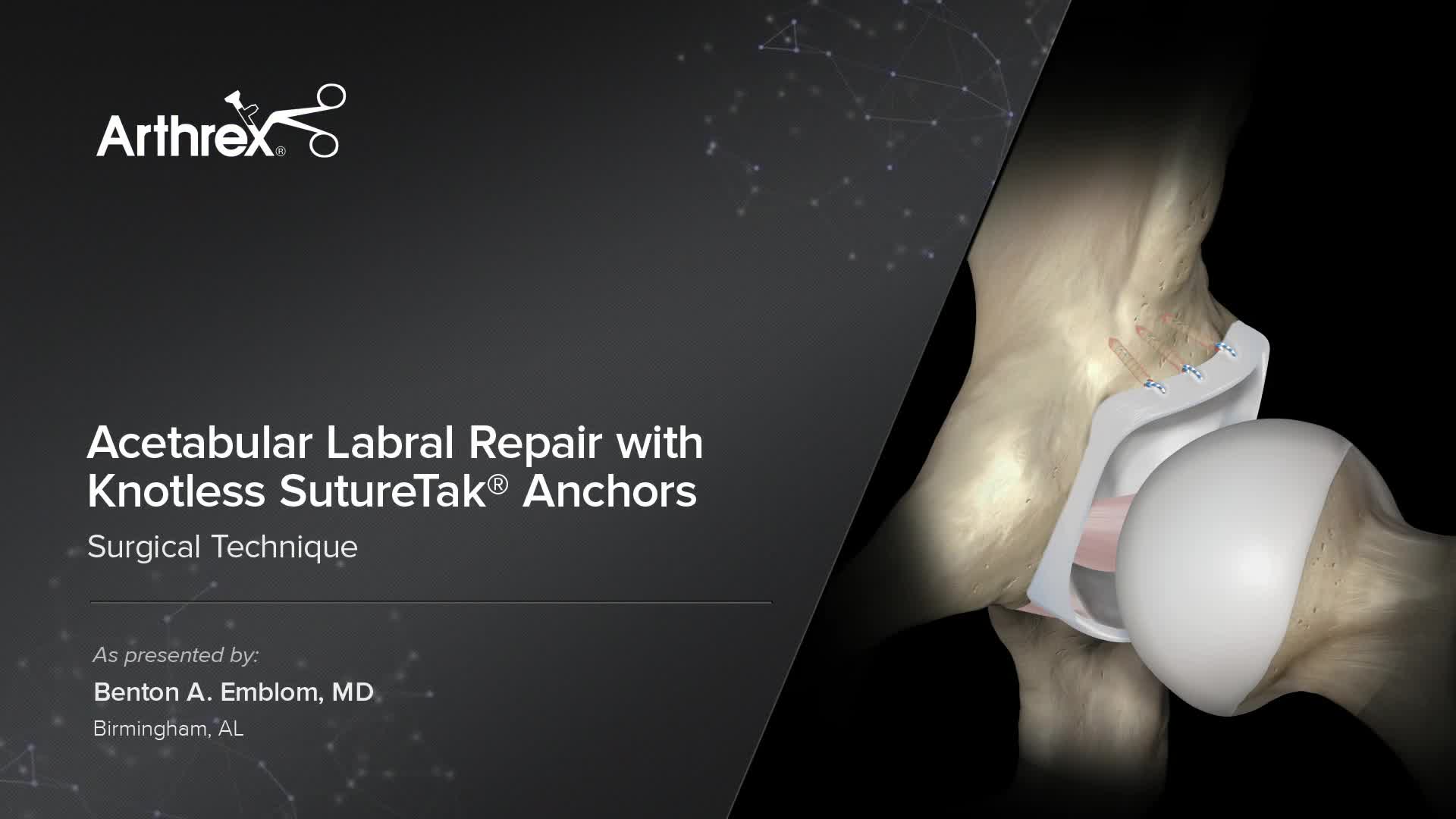 Arthrex Acetabular Labral Repair With Knotless Suturetak® Anchors