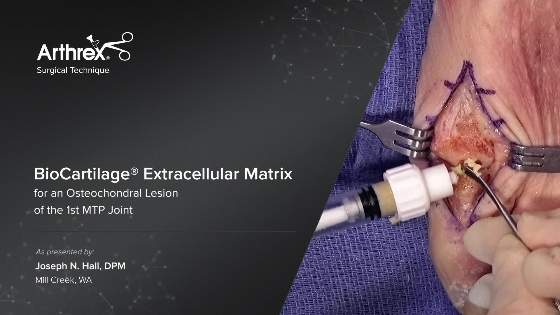 Arthrex BioCartilage® Extracellular Matrix for an Osteochondral