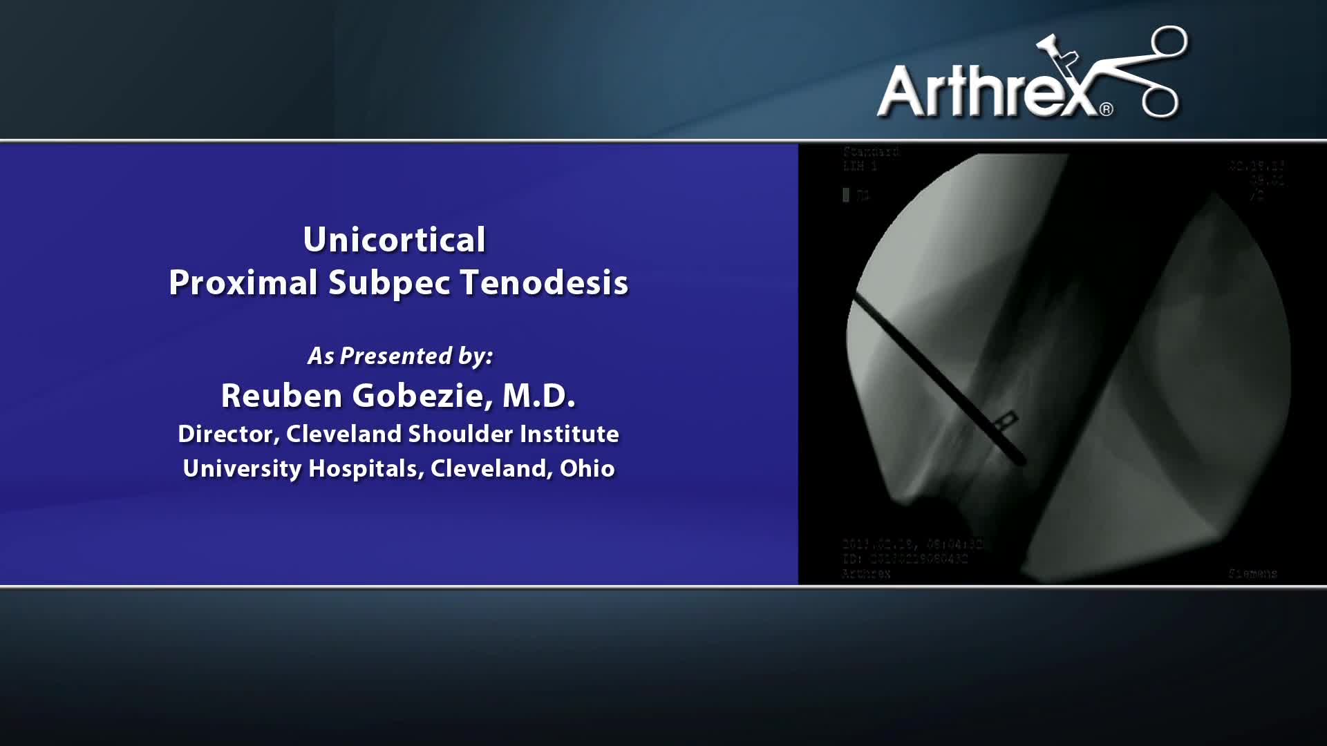 Arthrex - Unicortical Proximal Subpec Tenodesis