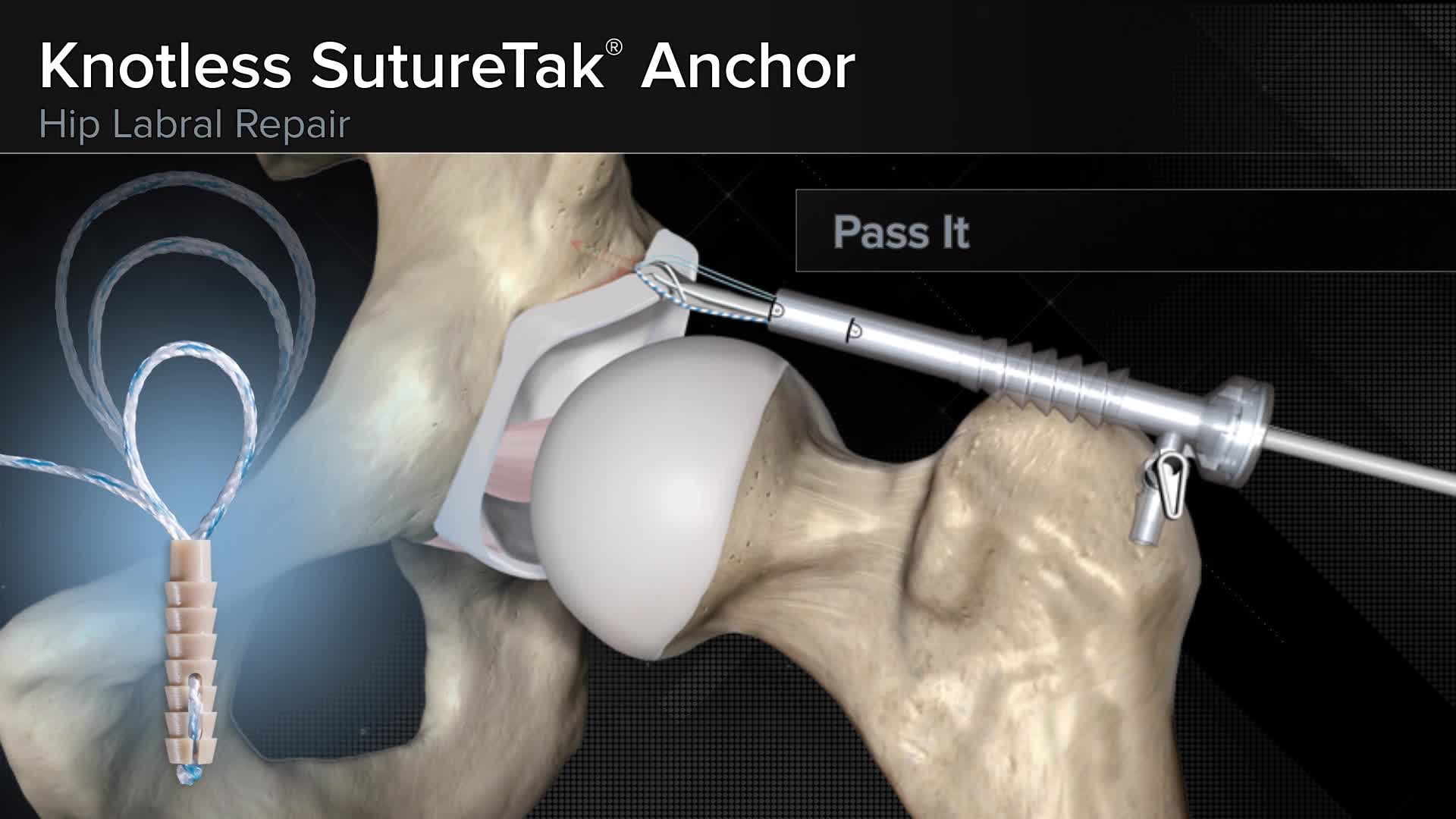 Arthrex Knotless Suturetak Anchor Hip Labral Repair