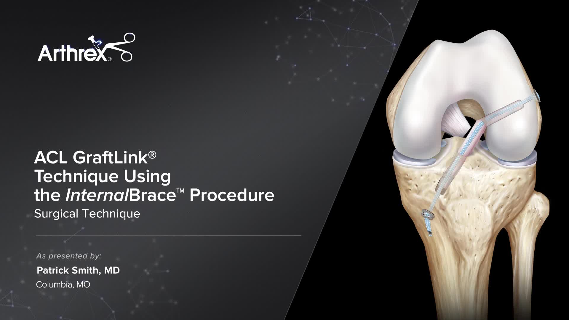 Arthrex Acl Graftlink Technique Using The Internalbrace Procedure