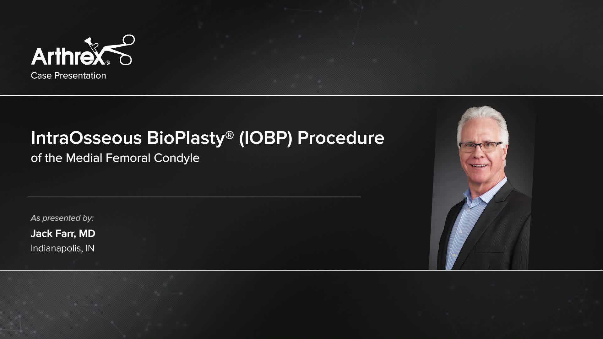 Arthrex - IntraOsseous BioPlasty® (IOBP) Procedure Of The Medial ...