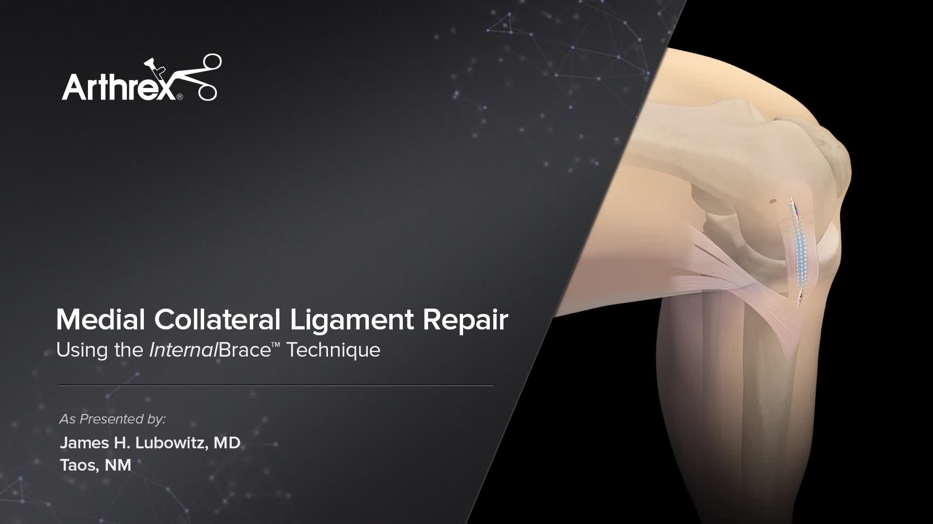 Arthrex - Medial Collateral Ligament Repair Using the InternalBrace™  Technique