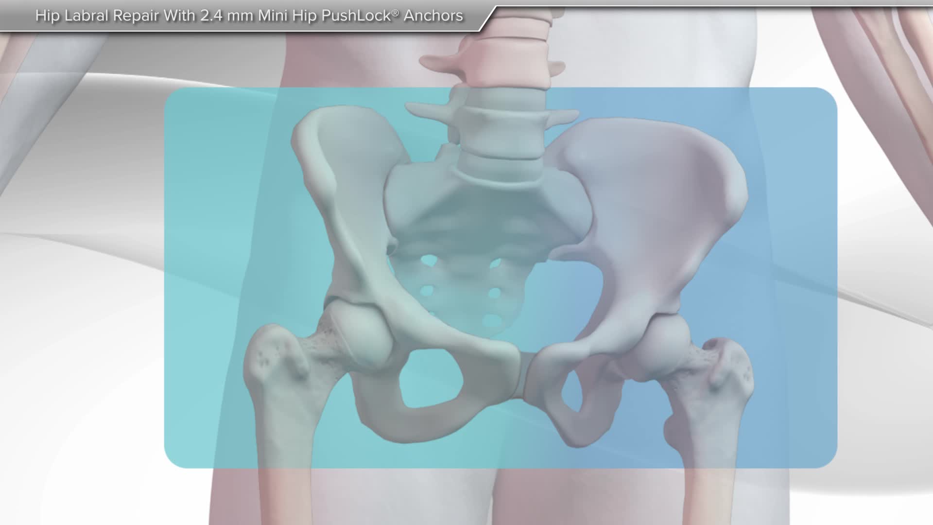 Arthrex Hip Labral Repair With 2 4 Mm Mini Hip Pushlock® Anchors