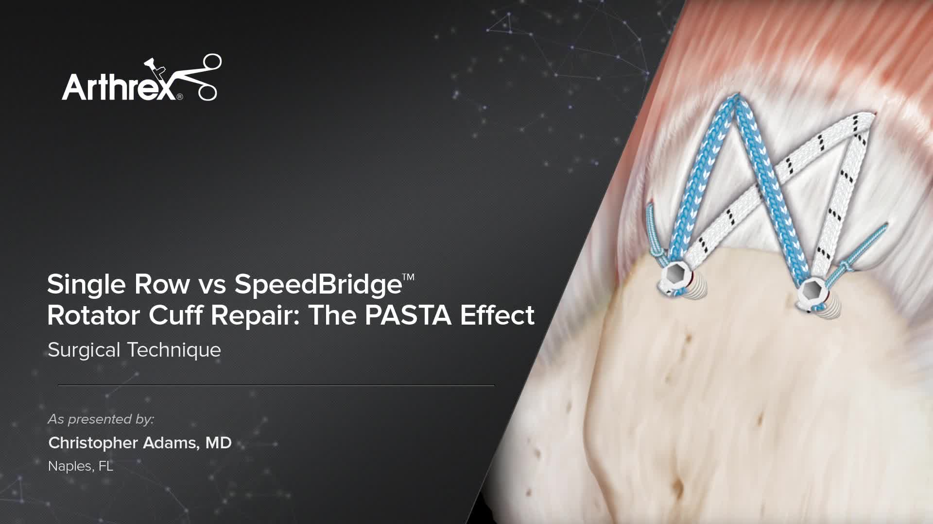 Arthrex - Single Row Vs SpeedBridge™ Rotator Cuff Repair: The PASTA Effect