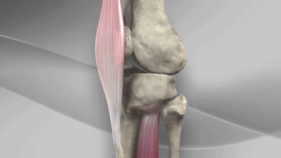 Arthrex Tibial Tubercle Osteotomy With T Amz System